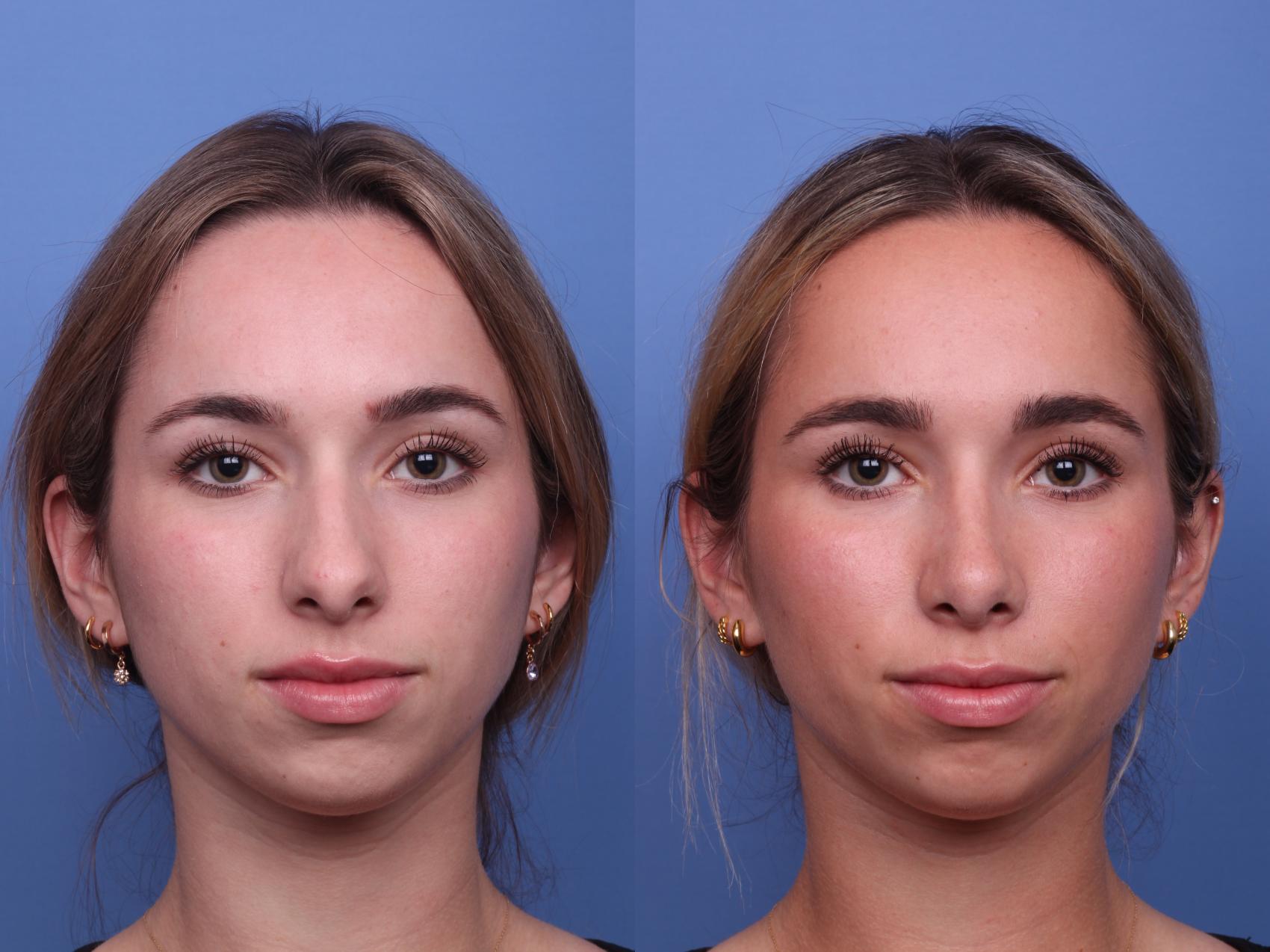 Before & After Rhinoplasty Case 482 Front View in Scottsdale, AZ