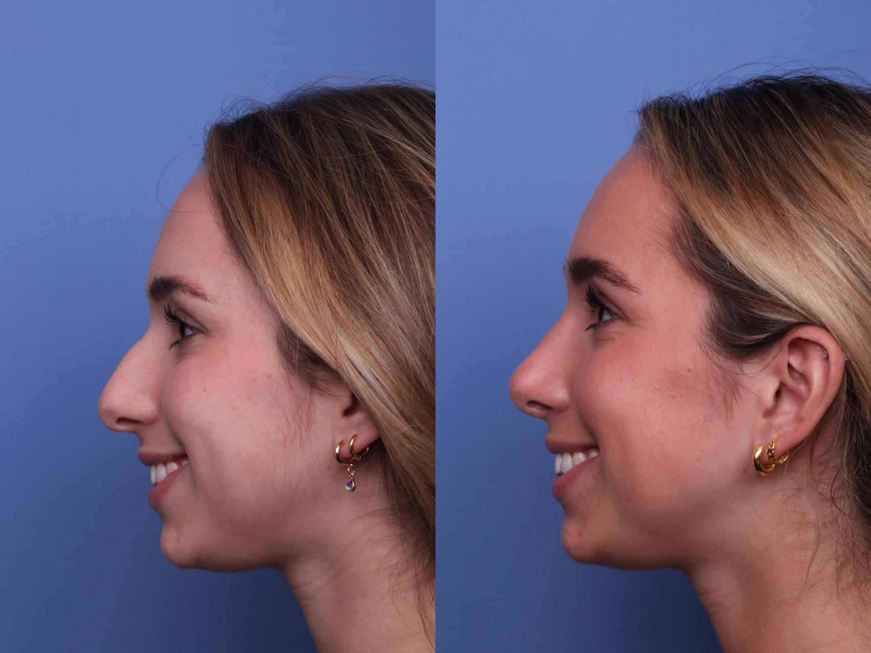 Before & After Rhinoplasty Case 482 Left Smile View in Scottsdale, AZ