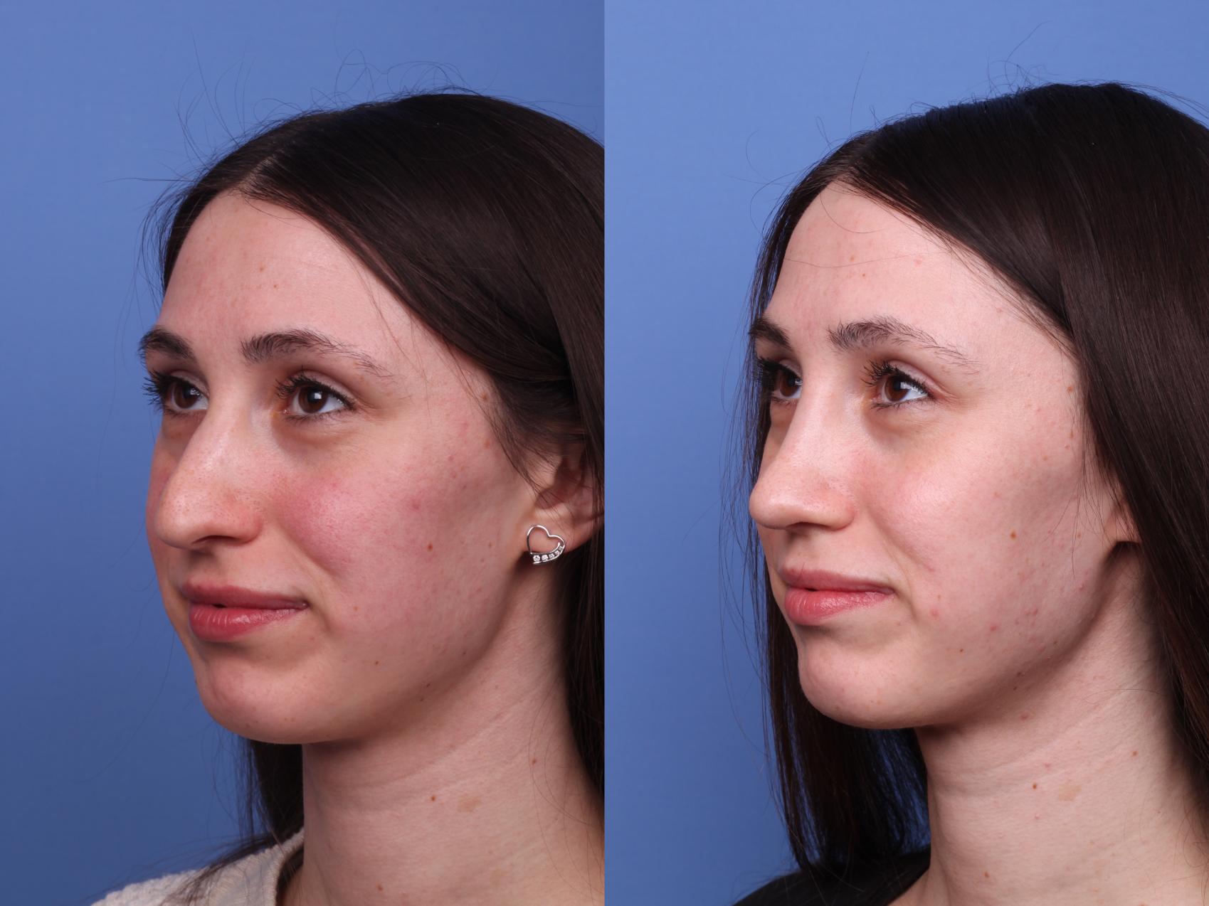 Before & After Rhinoplasty Case 483 Left Oblique View in Scottsdale, AZ