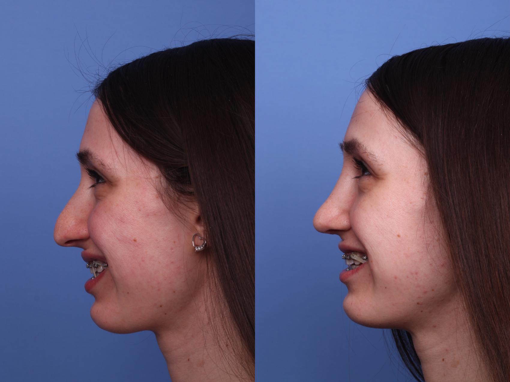 Before & After Rhinoplasty Case 483 Left Smile View in Scottsdale, AZ