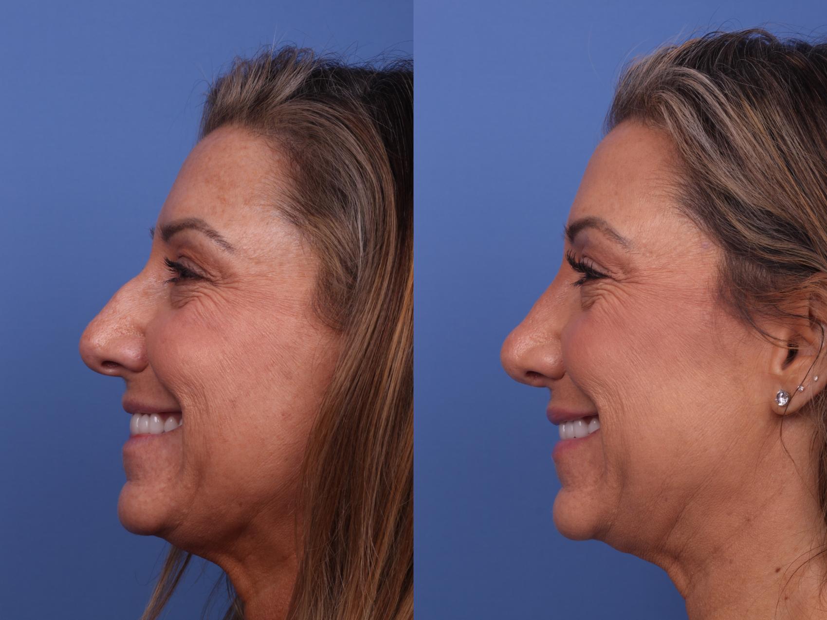 Before & After Rhinoplasty Case 484 Left Smile View in Scottsdale, AZ