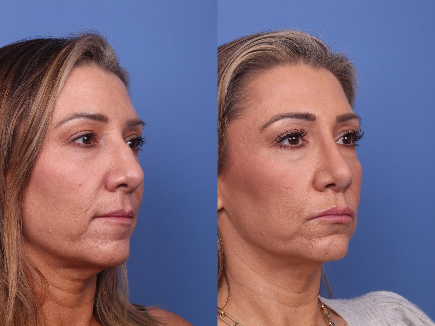 Before & After Rhinoplasty Case 484 Right Oblique View in Scottsdale, AZ