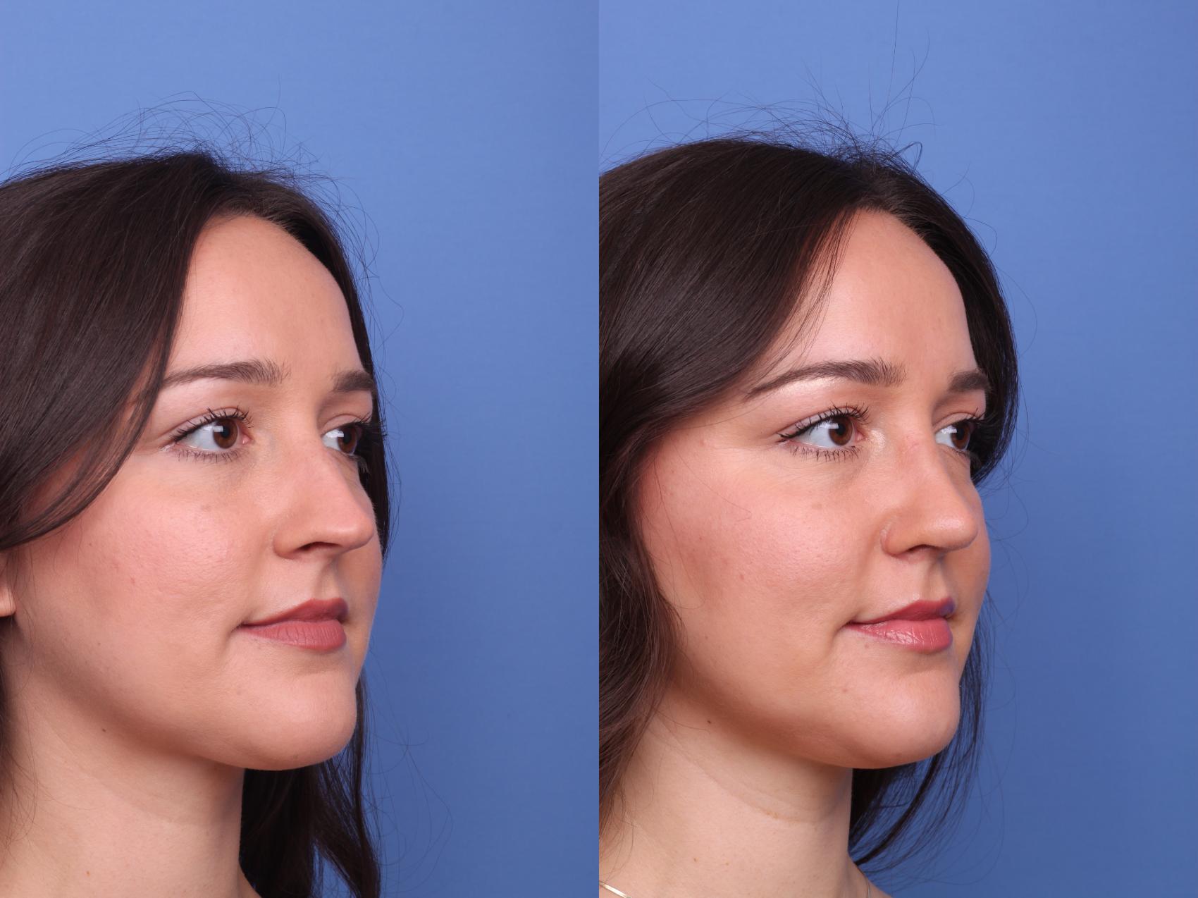 Before & After Rhinoplasty Case 486 Right Oblique View in Scottsdale, AZ