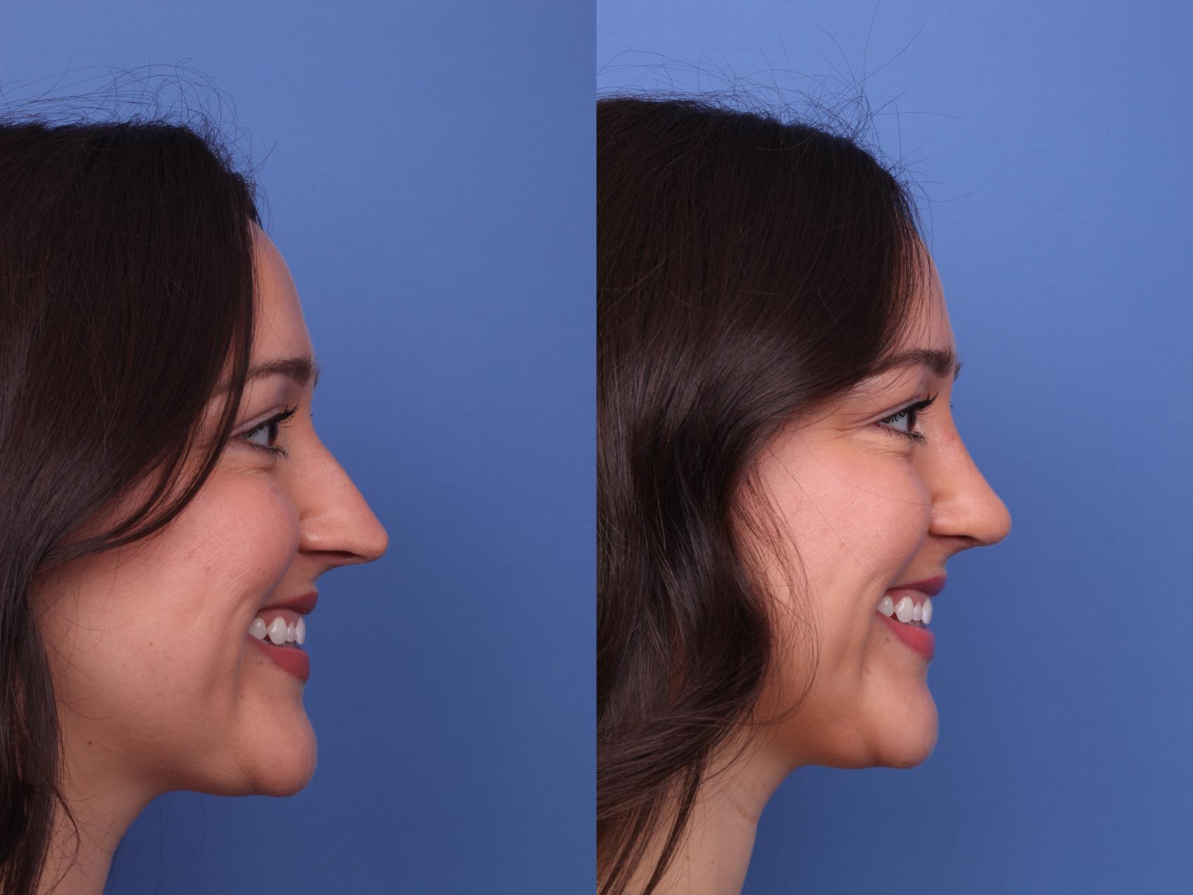 Before & After Rhinoplasty Case 486 Right Smile View in Scottsdale, AZ