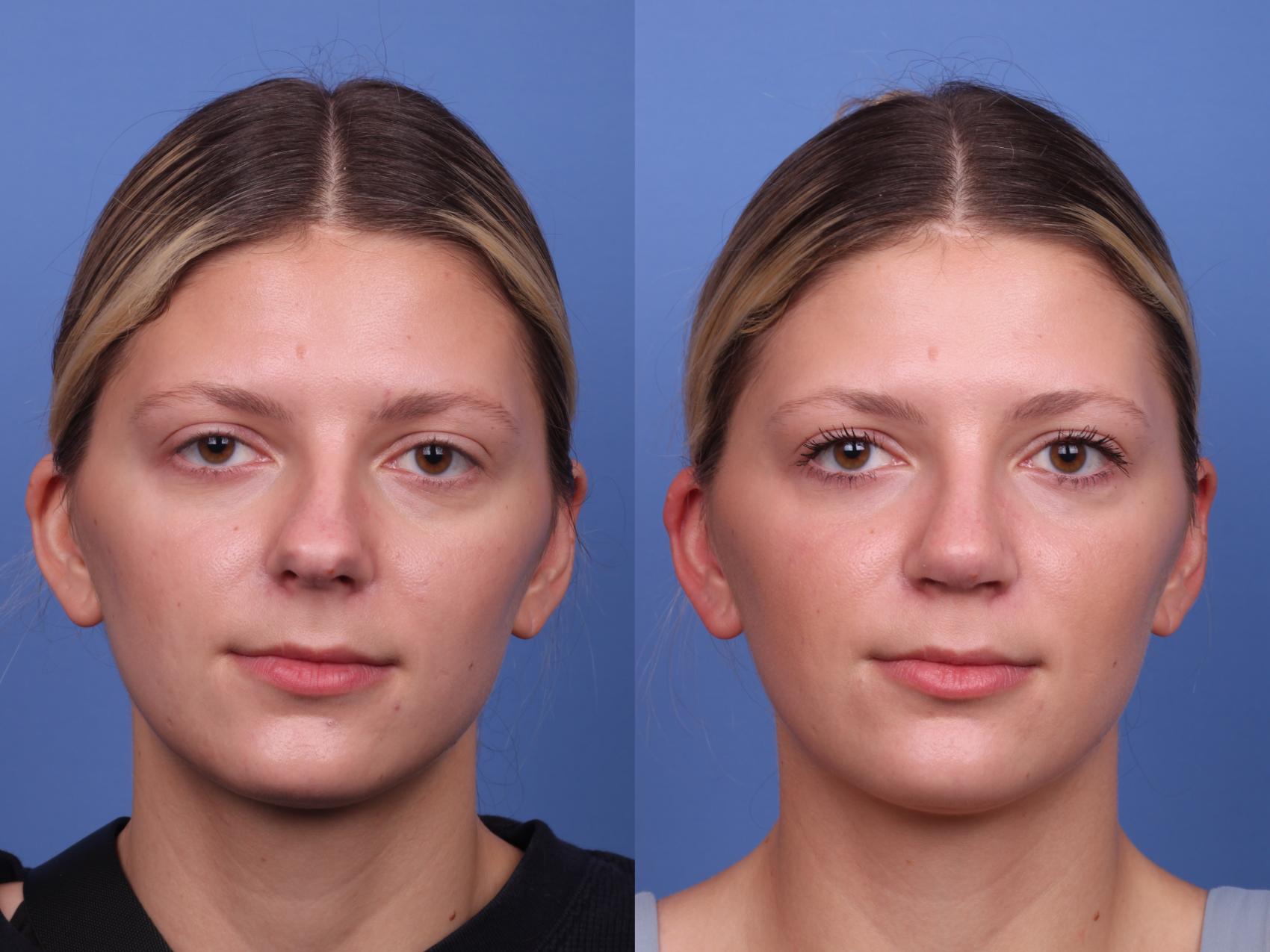 Before & After Rhinoplasty Case 490 Front View in Scottsdale, AZ