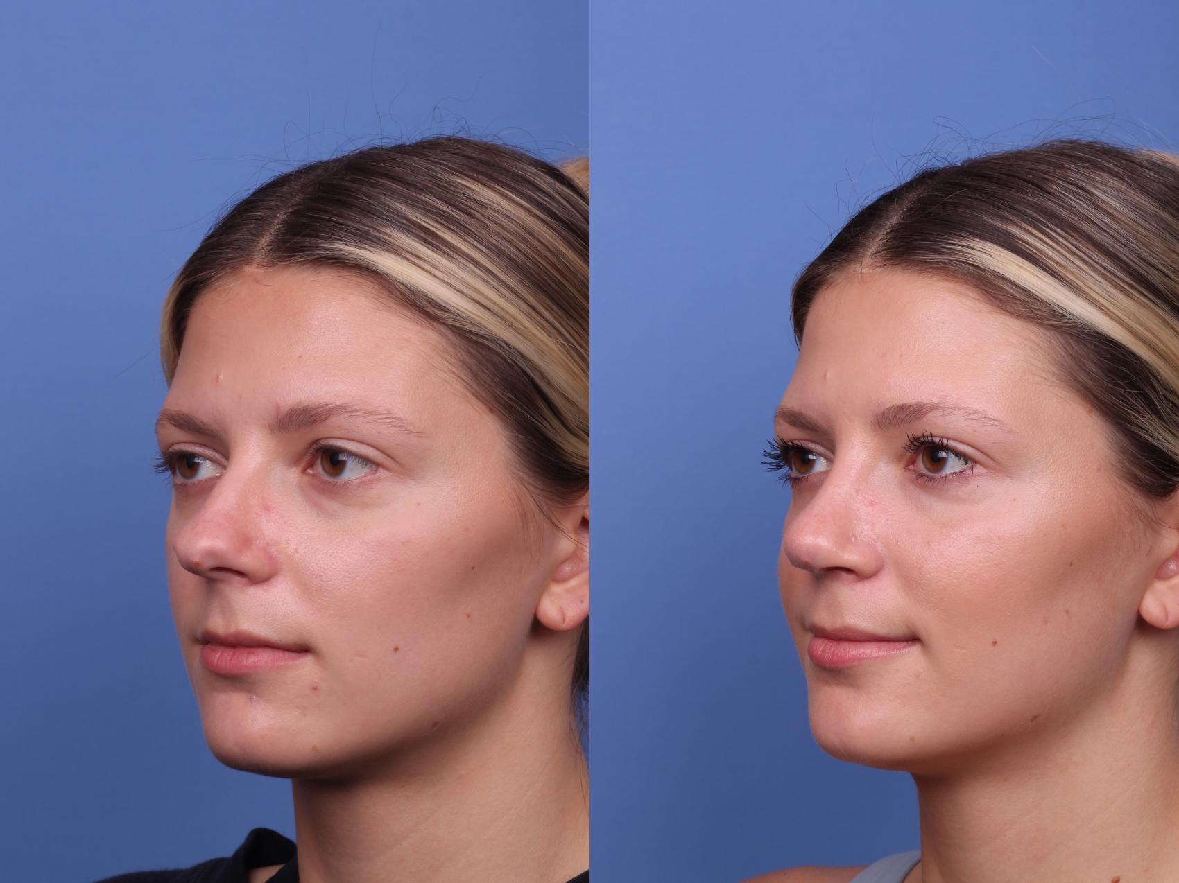 Before & After Rhinoplasty Case 490 Left Oblique View in Scottsdale, AZ
