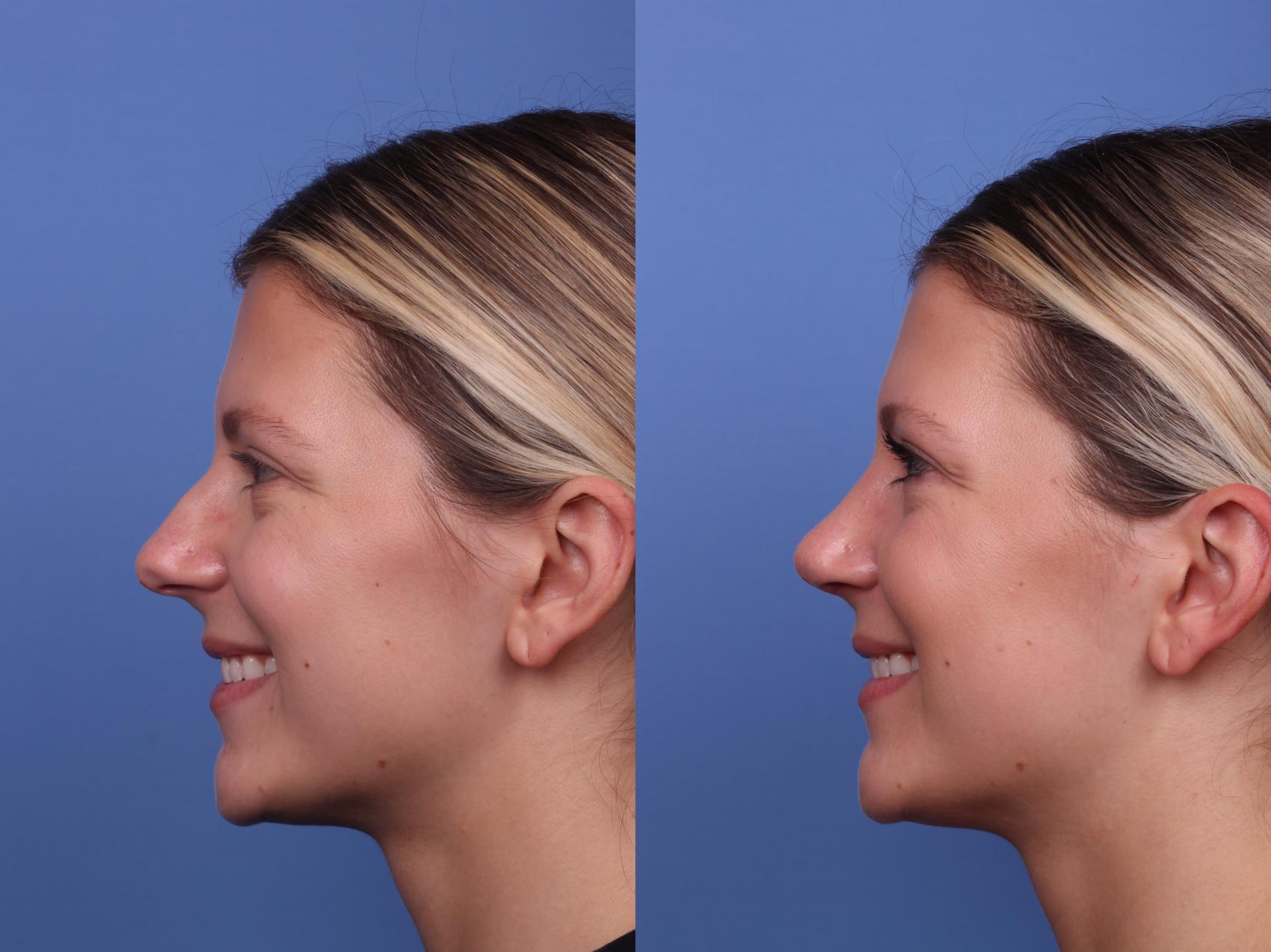 Before & After Rhinoplasty Case 490 Left Smile View in Scottsdale, AZ