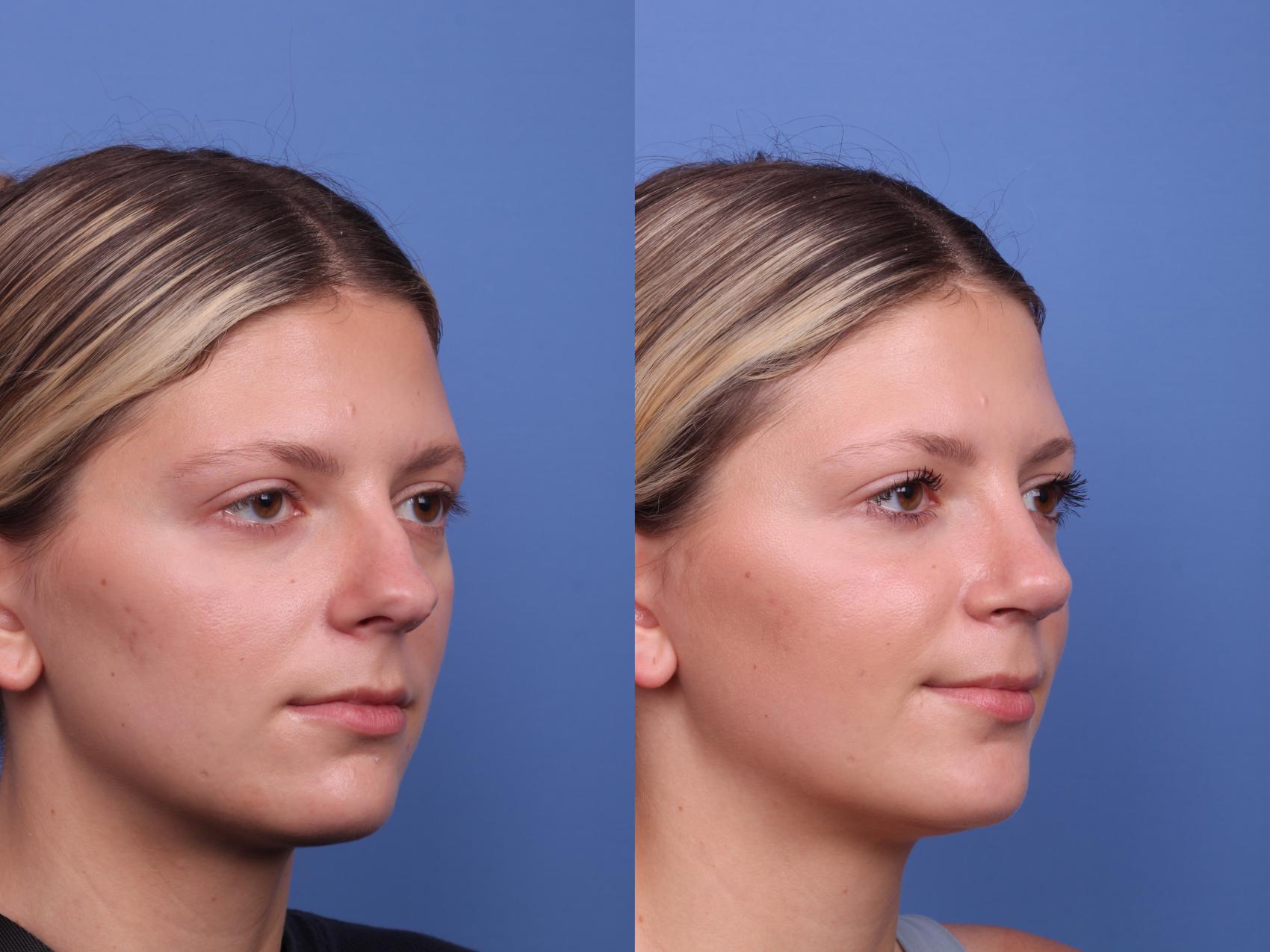Before & After Rhinoplasty Case 490 Right Oblique View in Scottsdale, AZ