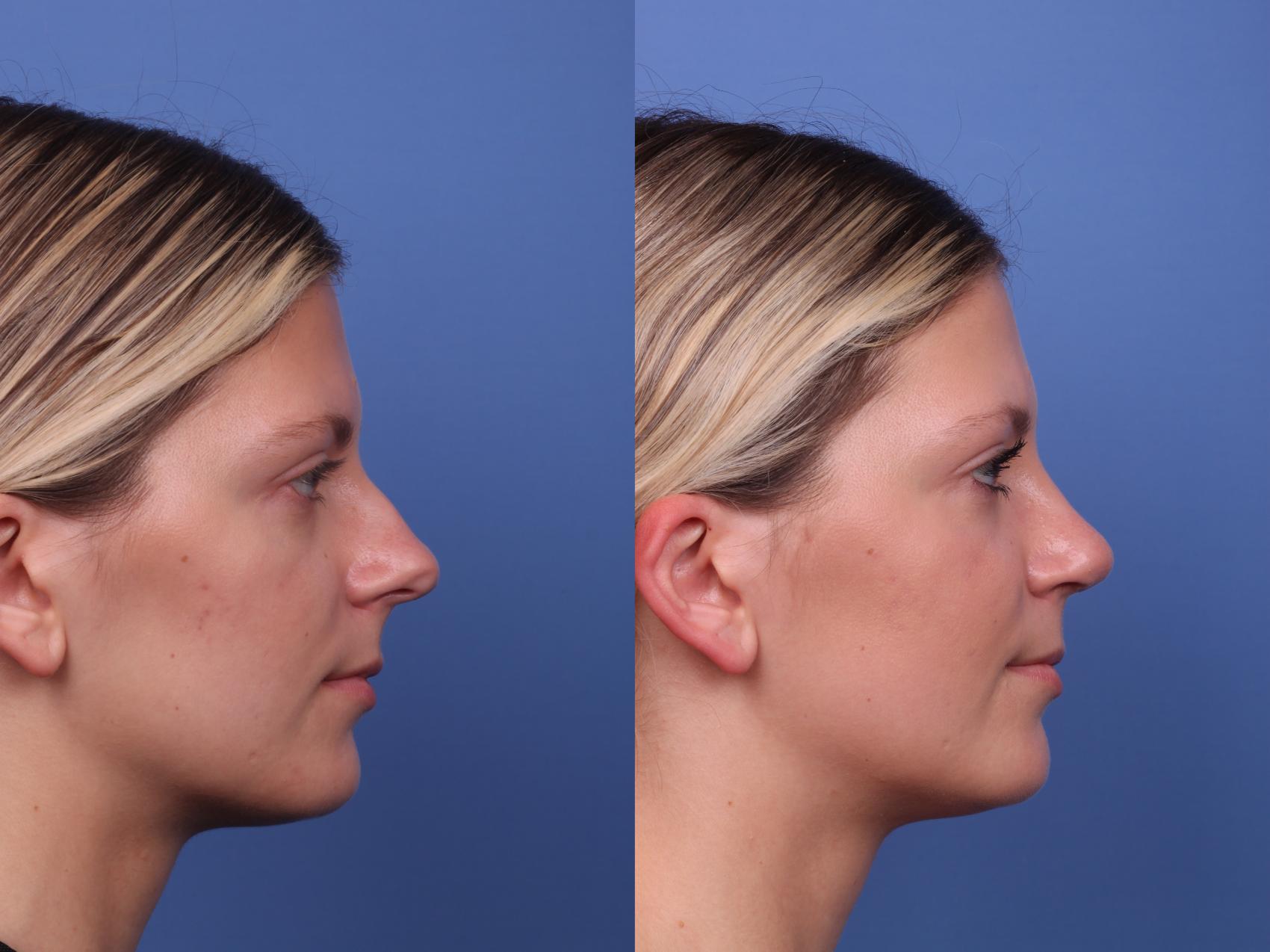 Before & After Rhinoplasty Case 490 Right Side View in Scottsdale, AZ