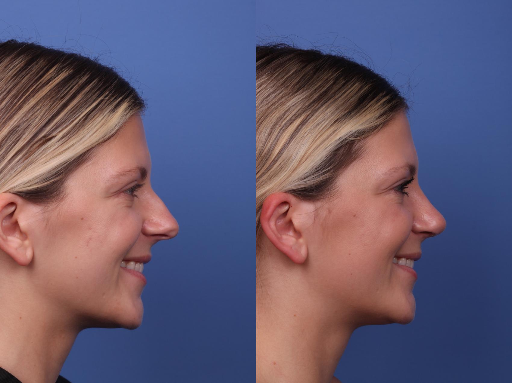 Before & After Rhinoplasty Case 490 Right Smile View in Scottsdale, AZ