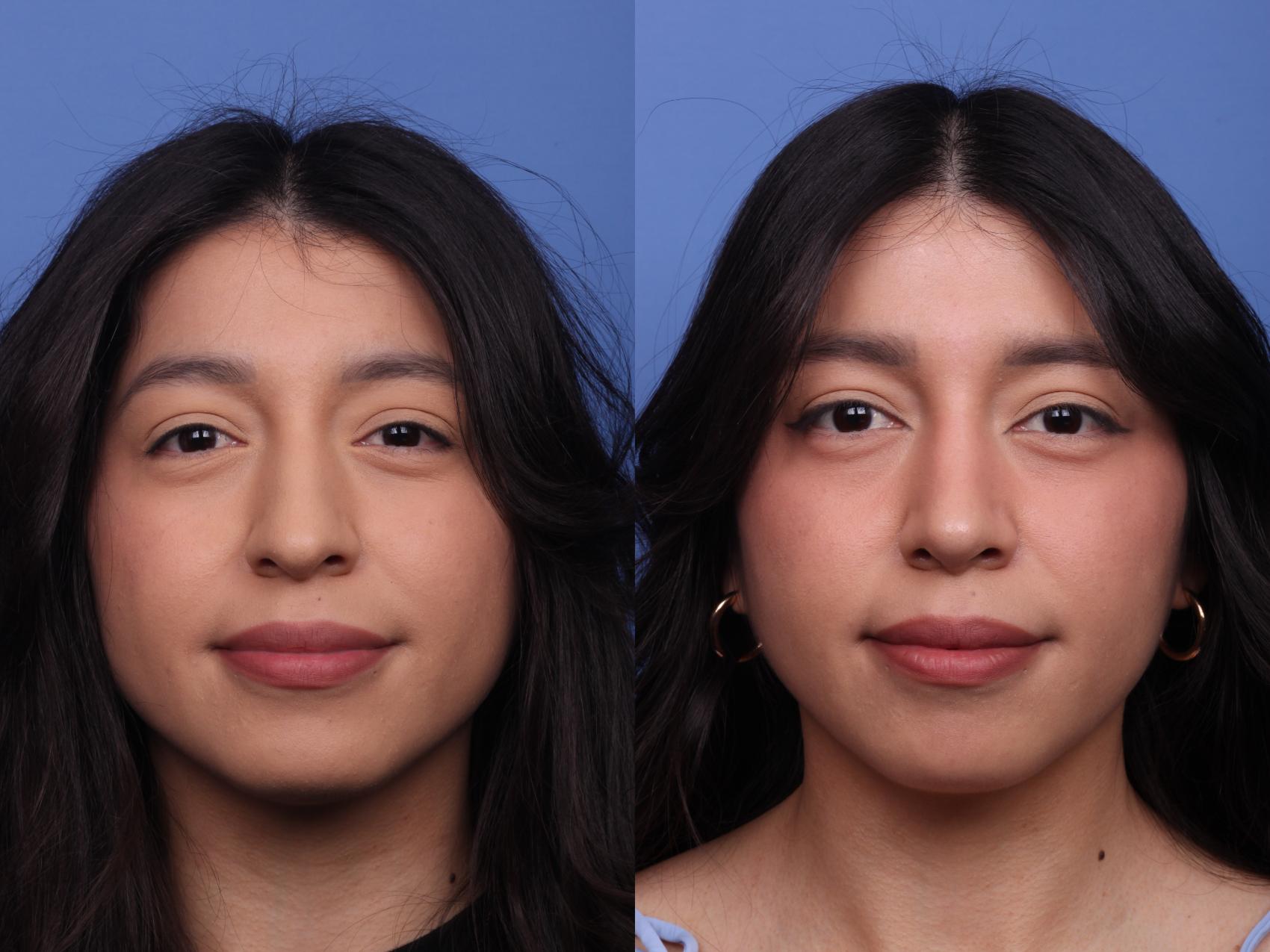 Before & After Rhinoplasty Case 491 Front View in Scottsdale, AZ
