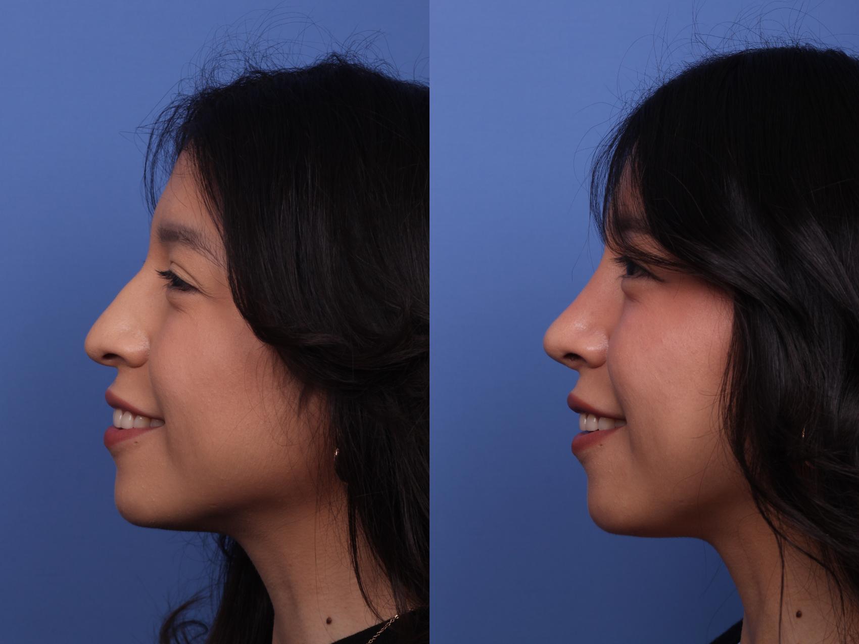 Before & After Rhinoplasty Case 491 Left Smile View in Scottsdale, AZ