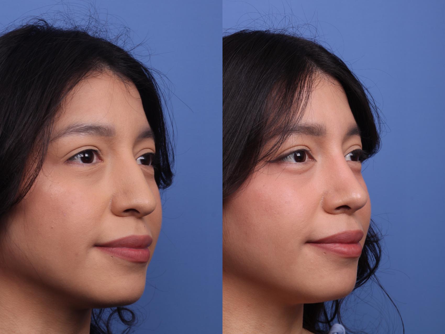 Before & After Rhinoplasty Case 491 Right Oblique View in Scottsdale, AZ