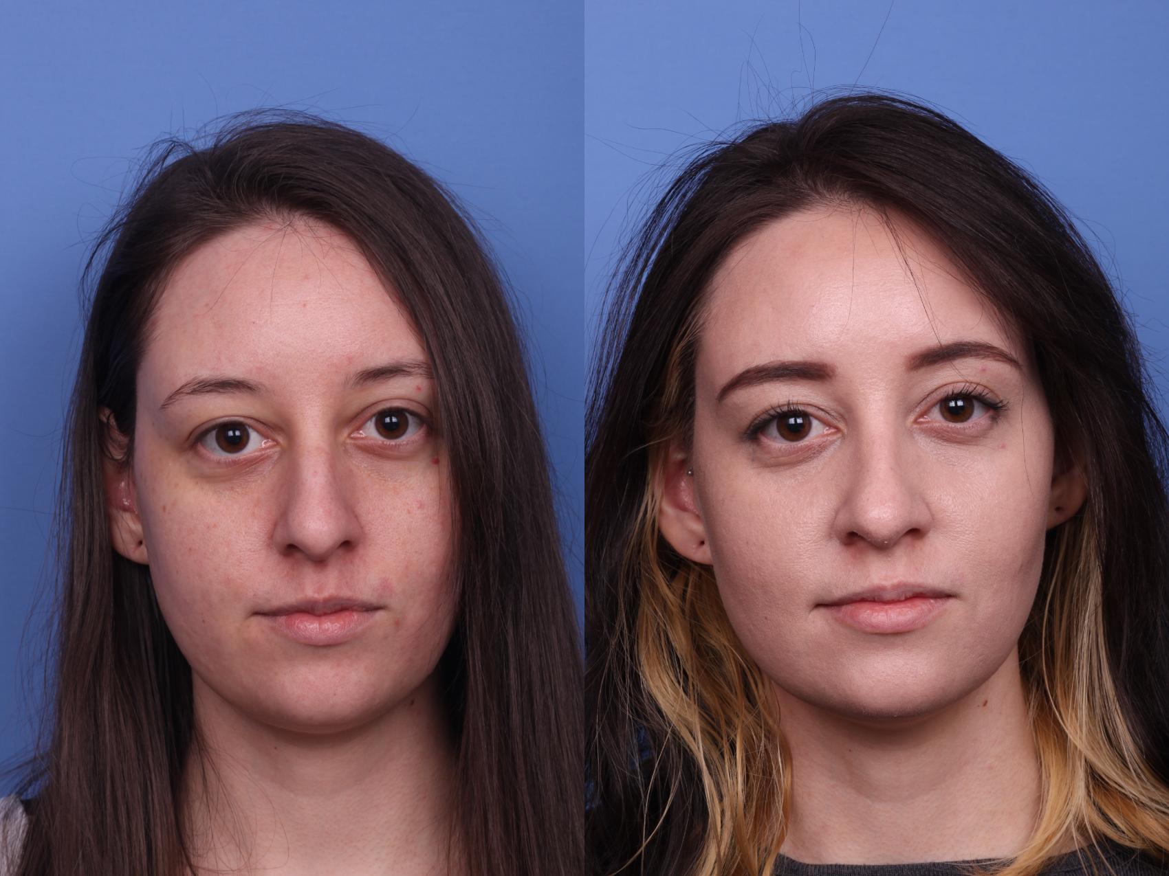 Before & After Rhinoplasty Case 492 Front View in Scottsdale, AZ