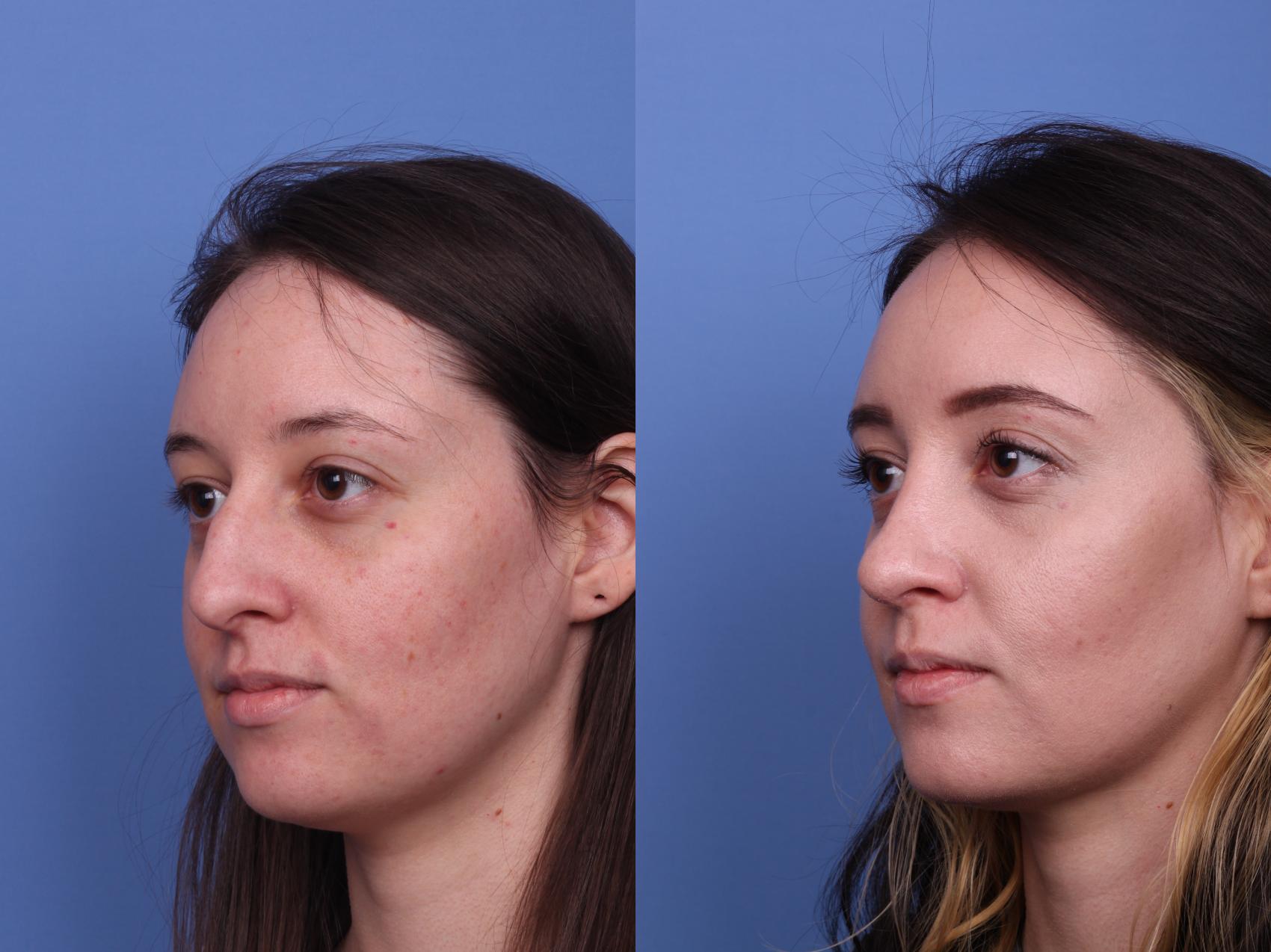 Before & After Rhinoplasty Case 492 Left Oblique View in Scottsdale, AZ