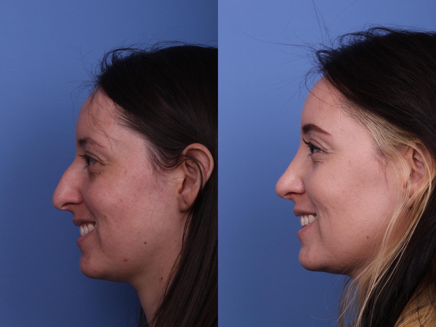 Before & After Rhinoplasty Case 492 Left Smile View in Scottsdale, AZ