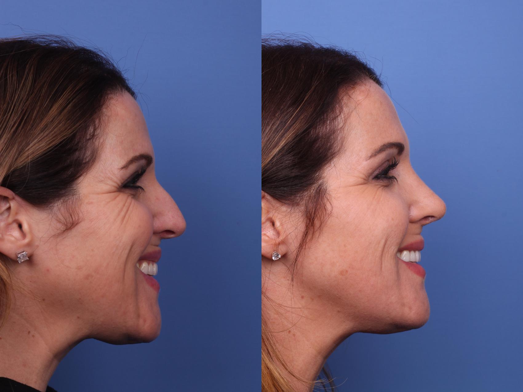 Before & After Rhinoplasty Case 494 Right Smile View in Scottsdale, AZ