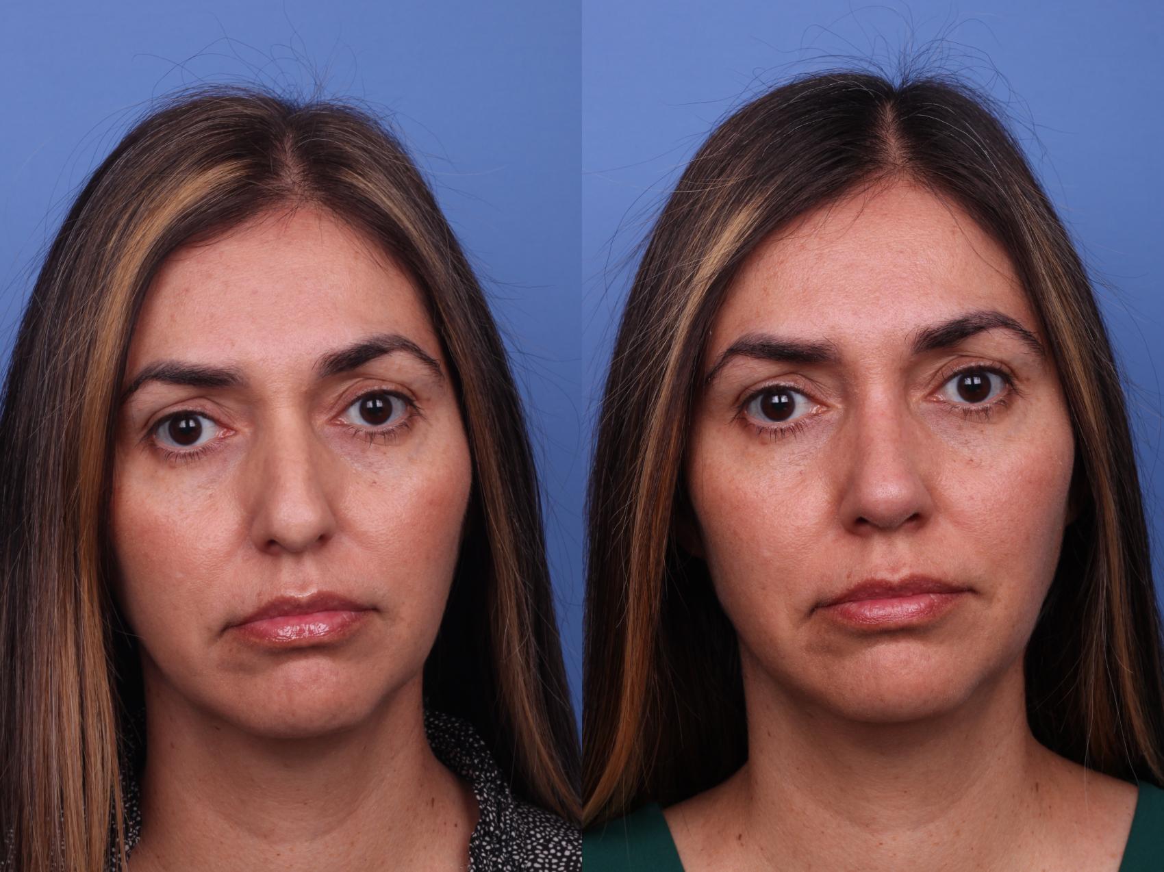 Before & After Rhinoplasty Case 495 Front View in Scottsdale, AZ