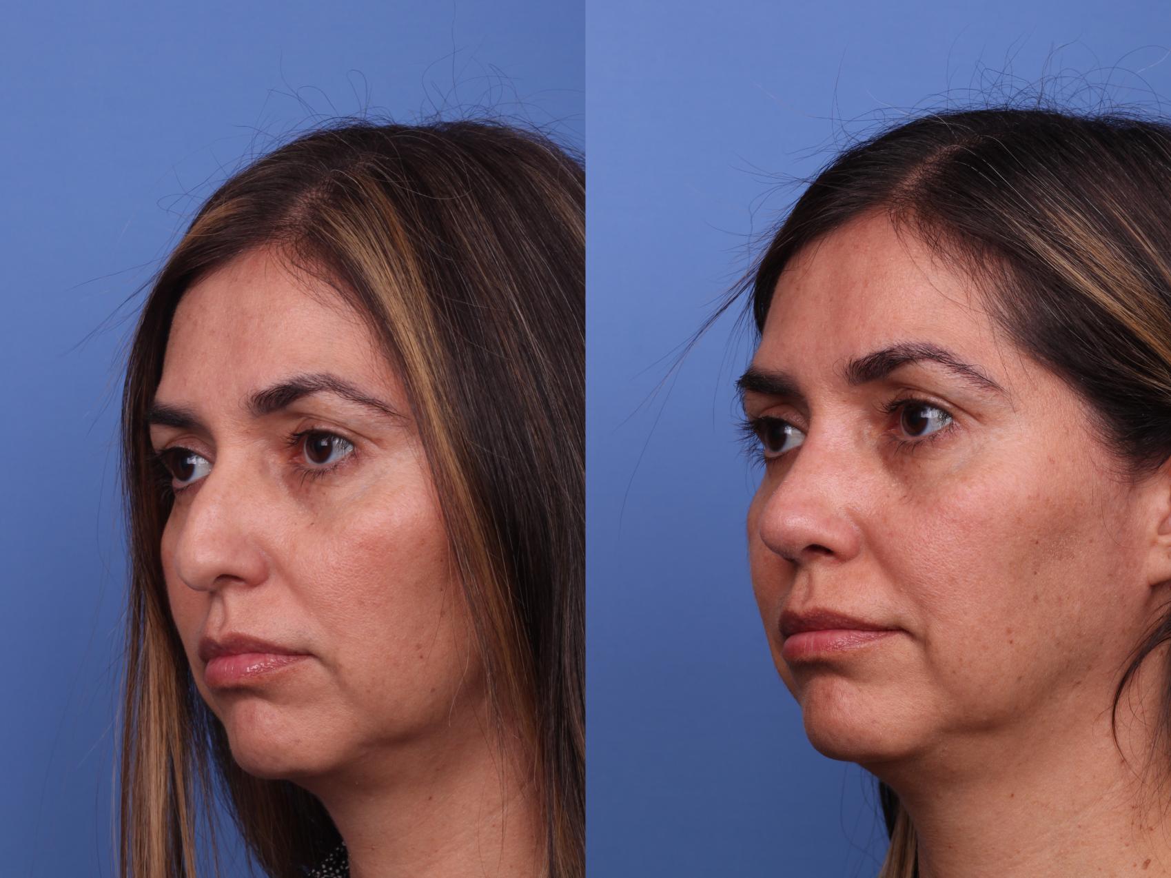 Before & After Rhinoplasty Case 495 Left Oblique View in Scottsdale, AZ