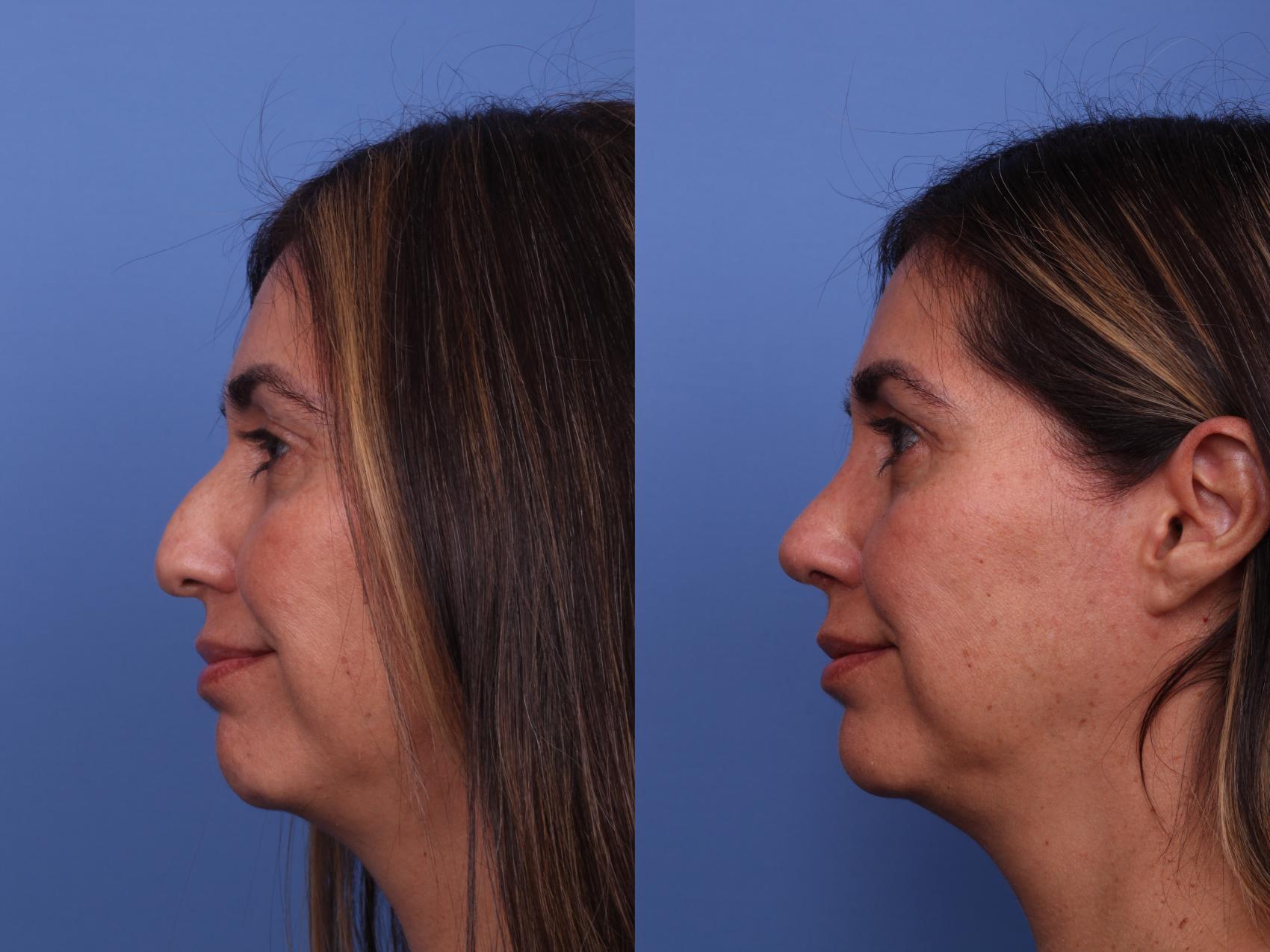 Before & After Rhinoplasty Case 495 Left Smile View in Scottsdale, AZ