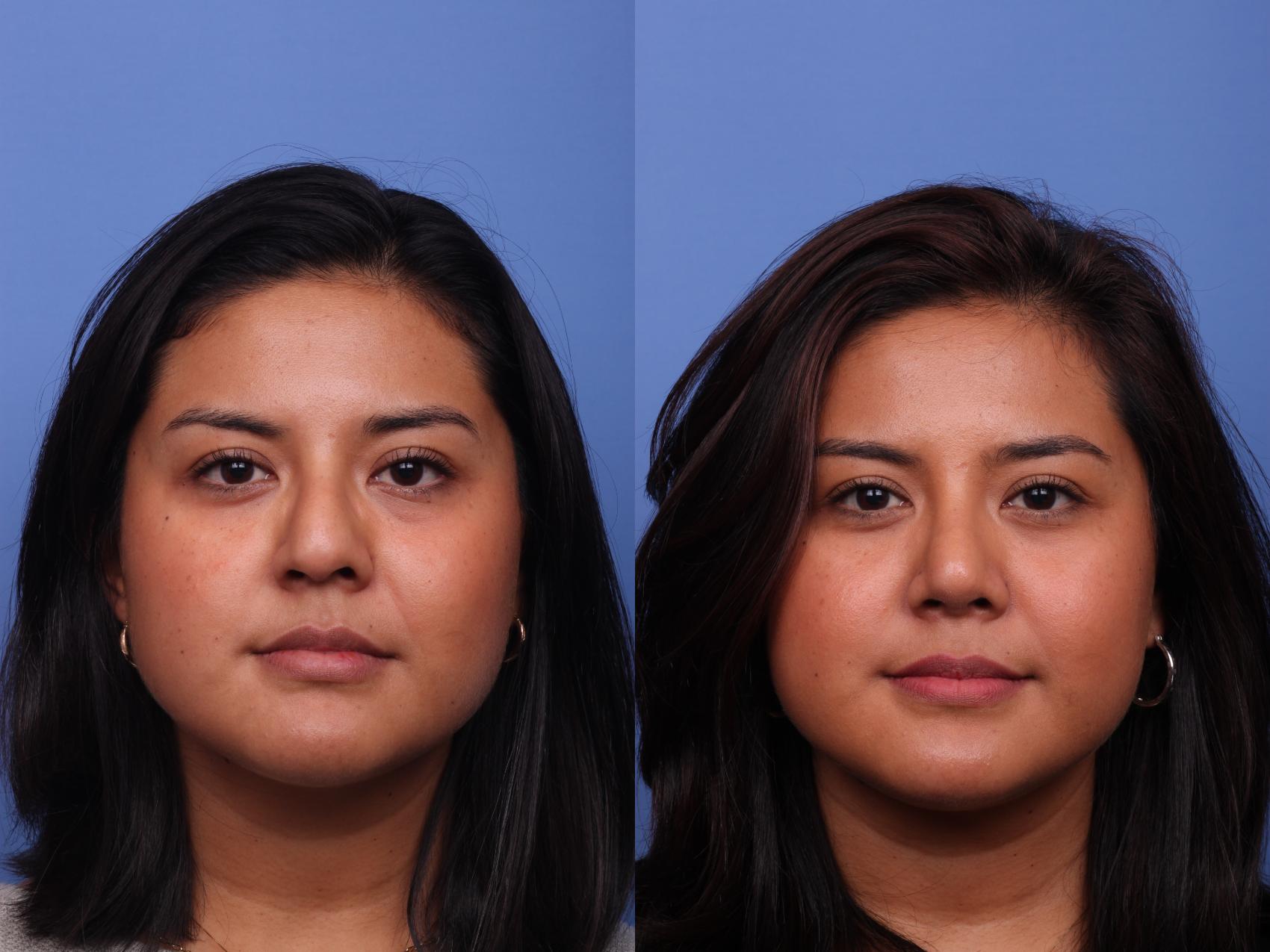 Before & After Rhinoplasty Case 496 Front View in Scottsdale, AZ