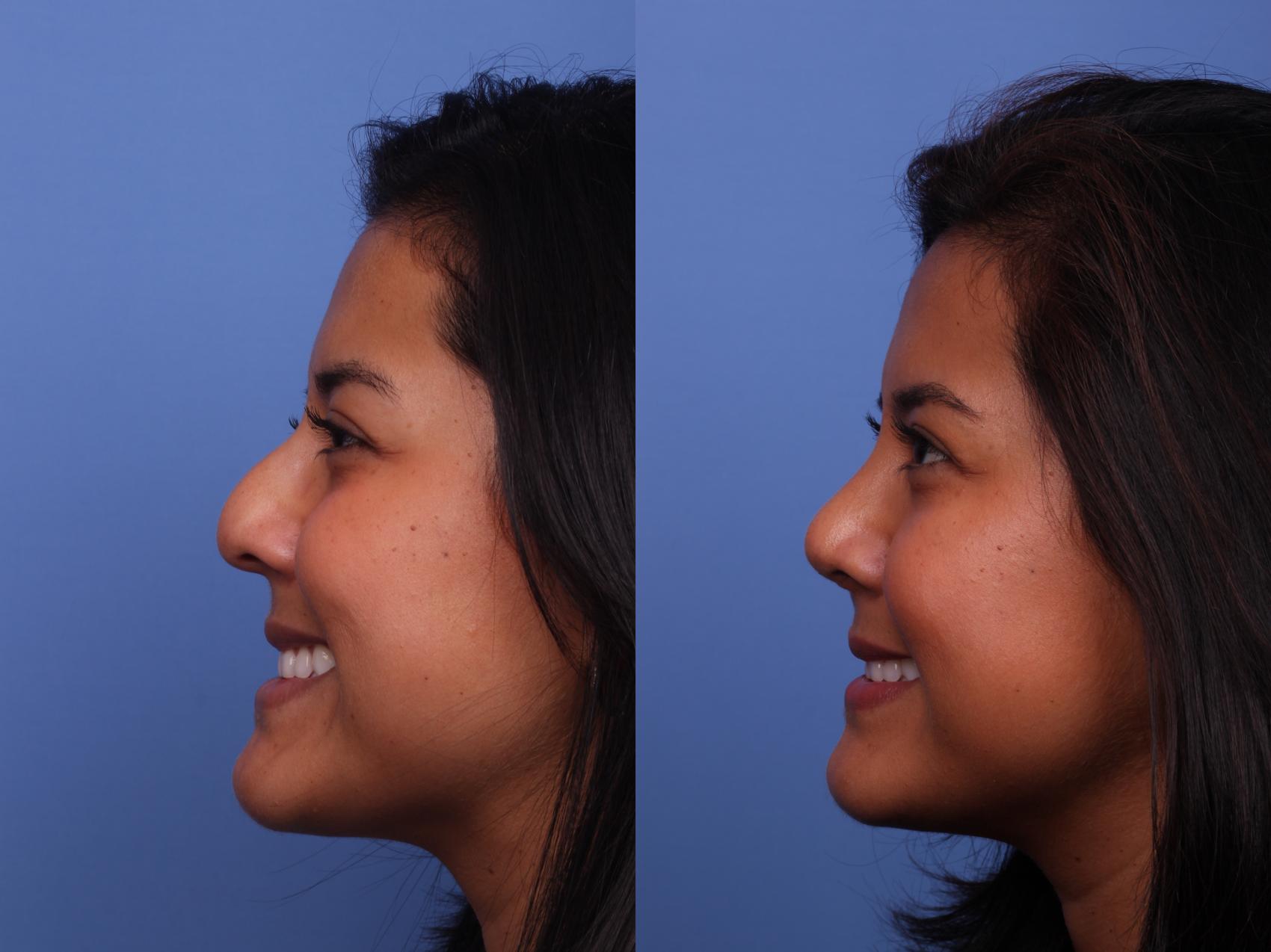 Before & After Rhinoplasty Case 496 Left Smile View in Scottsdale, AZ