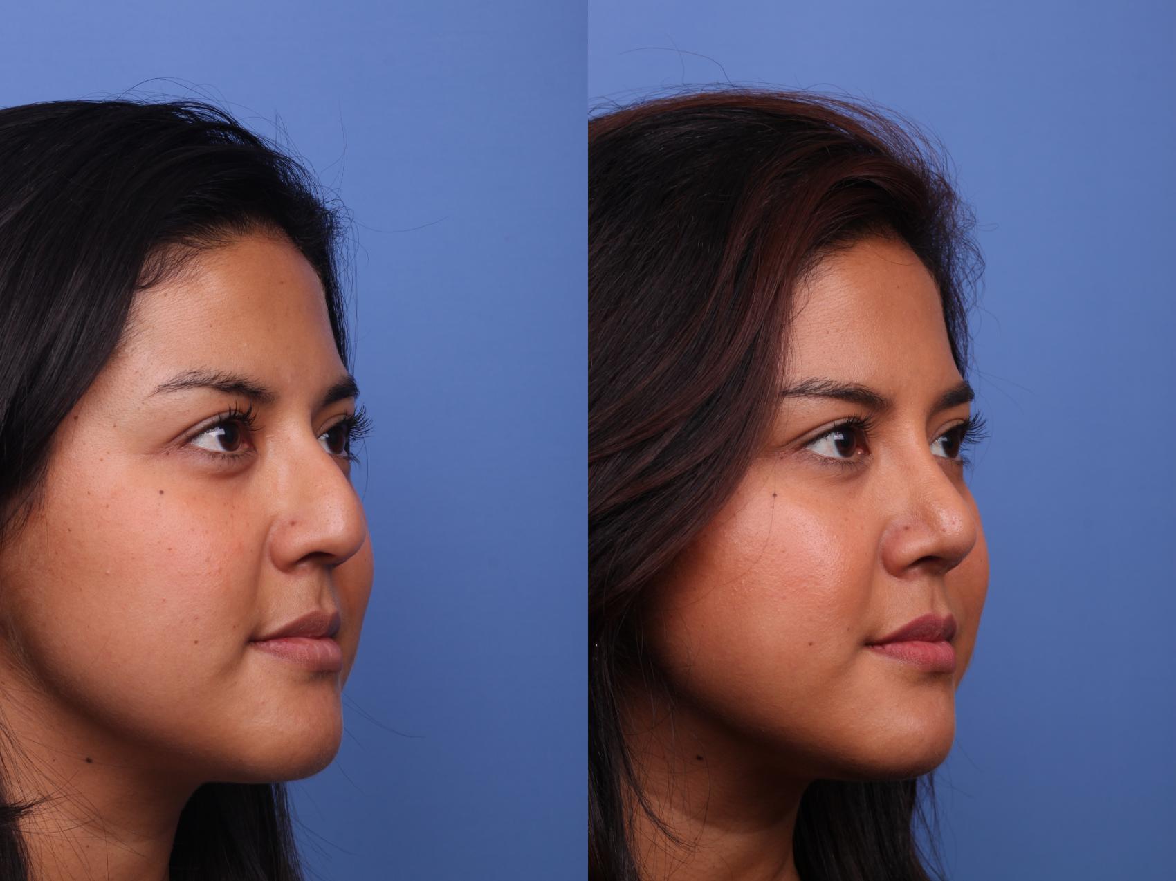 Before & After Rhinoplasty Case 496 Right Oblique View in Scottsdale, AZ