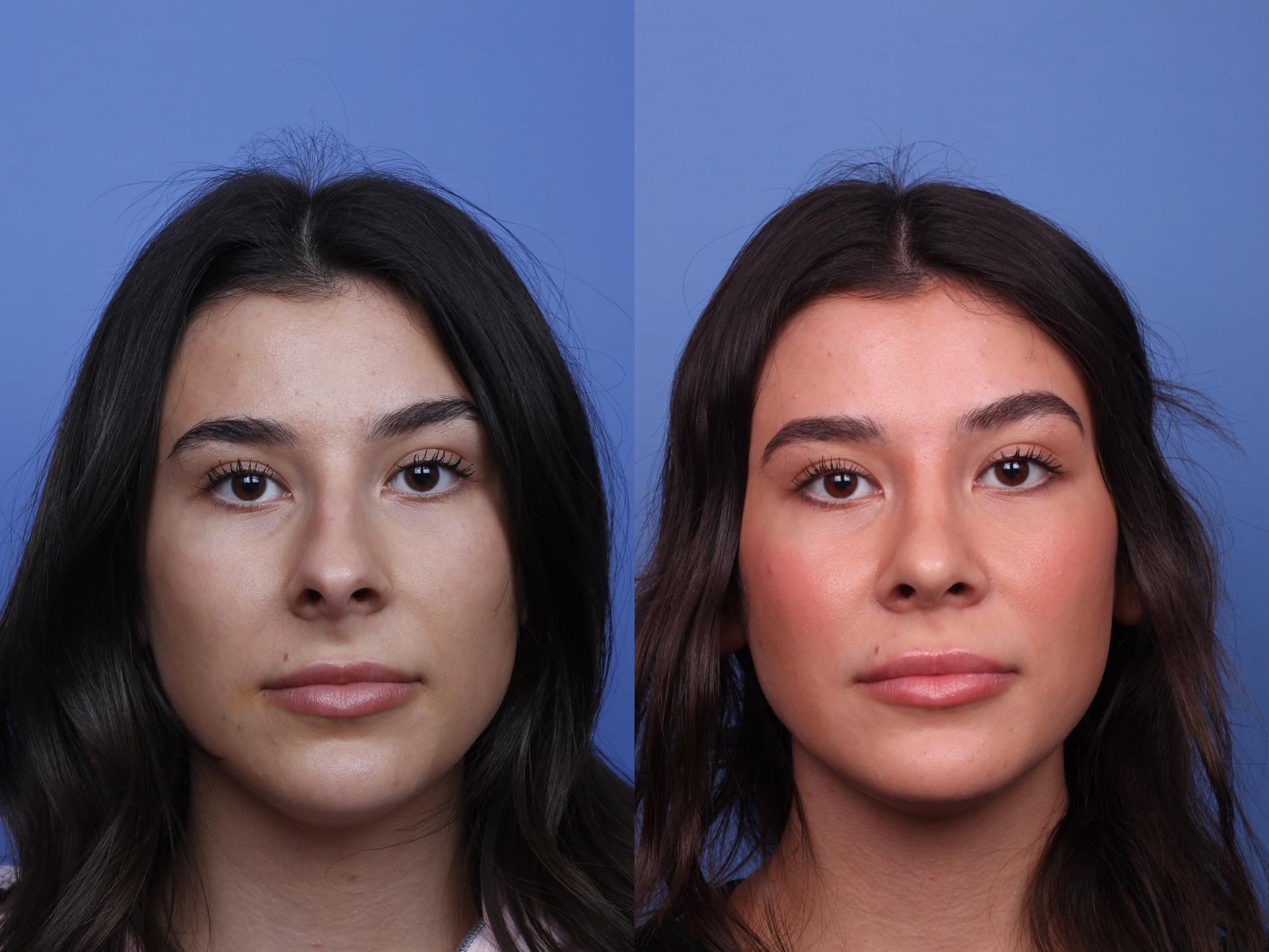 Before & After Rhinoplasty Case 497 Front View in Scottsdale, AZ