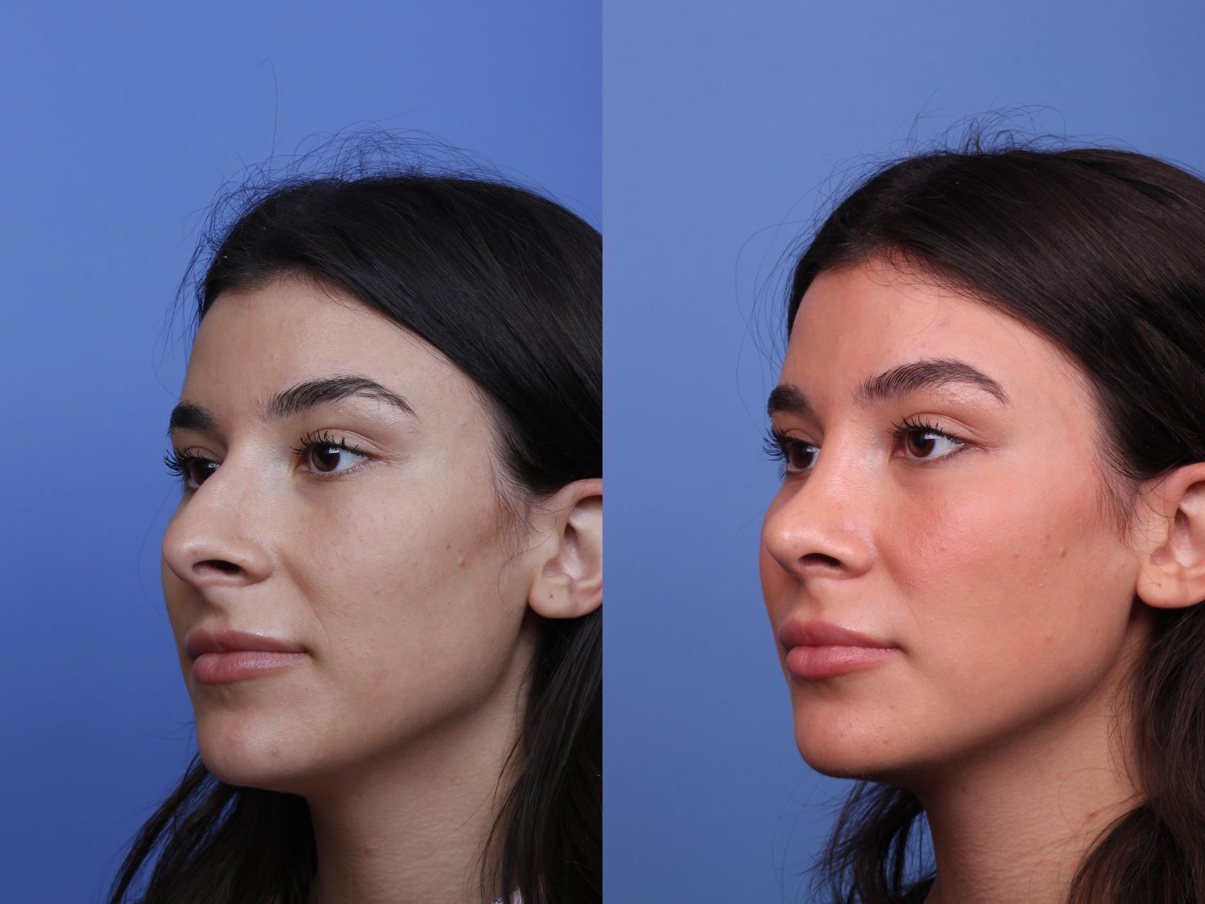 Before & After Rhinoplasty Case 497 Left Oblique View in Scottsdale, AZ