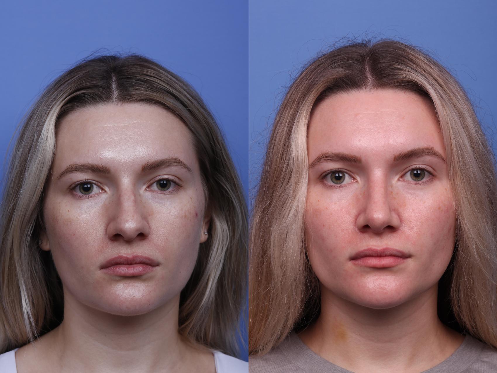 Before & After Rhinoplasty Case 498 Front View in Scottsdale, AZ
