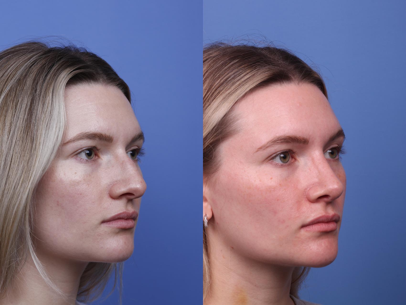Before & After Rhinoplasty Case 498 Right Oblique View in Scottsdale, AZ