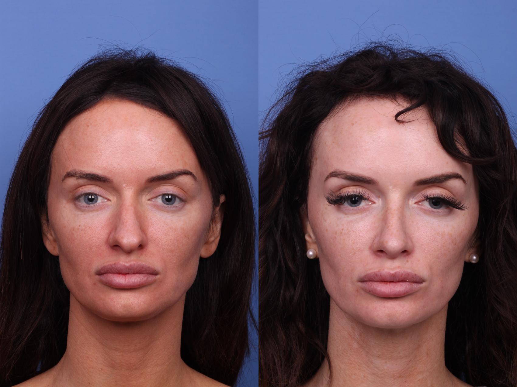 Before & After Rhinoplasty Case 499 Front View in Scottsdale, AZ