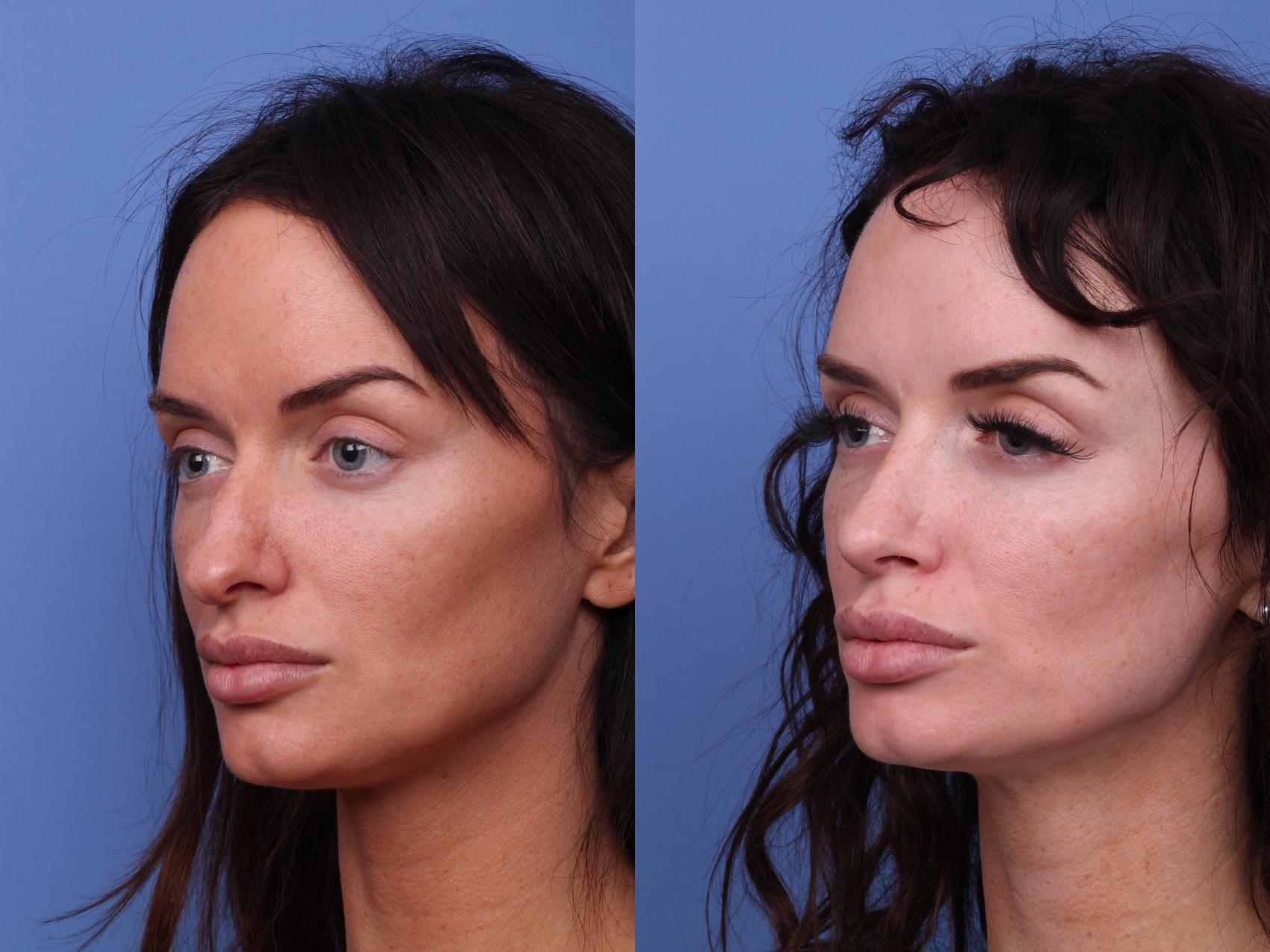 Before & After Rhinoplasty Case 499 Left Oblique View in Scottsdale, AZ