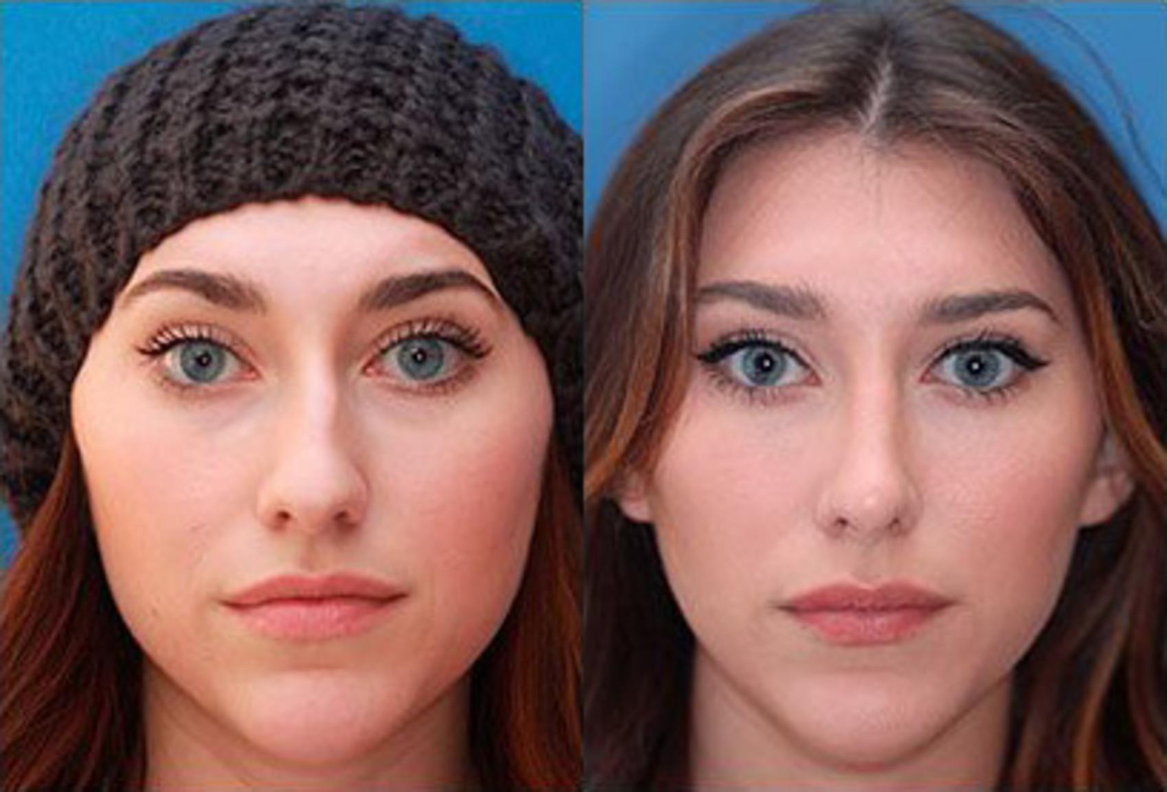 Before & After Rhinoplasty Case 50 View #2 View in Scottsdale, AZ