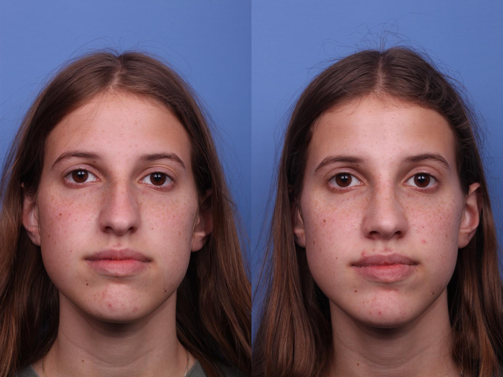 Before & After Rhinoplasty Case 500 Front View in Scottsdale, AZ