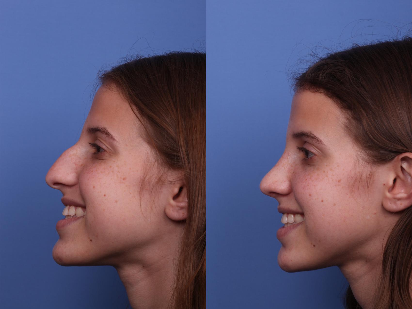 Before & After Rhinoplasty Case 500 Left Smile View in Scottsdale, AZ