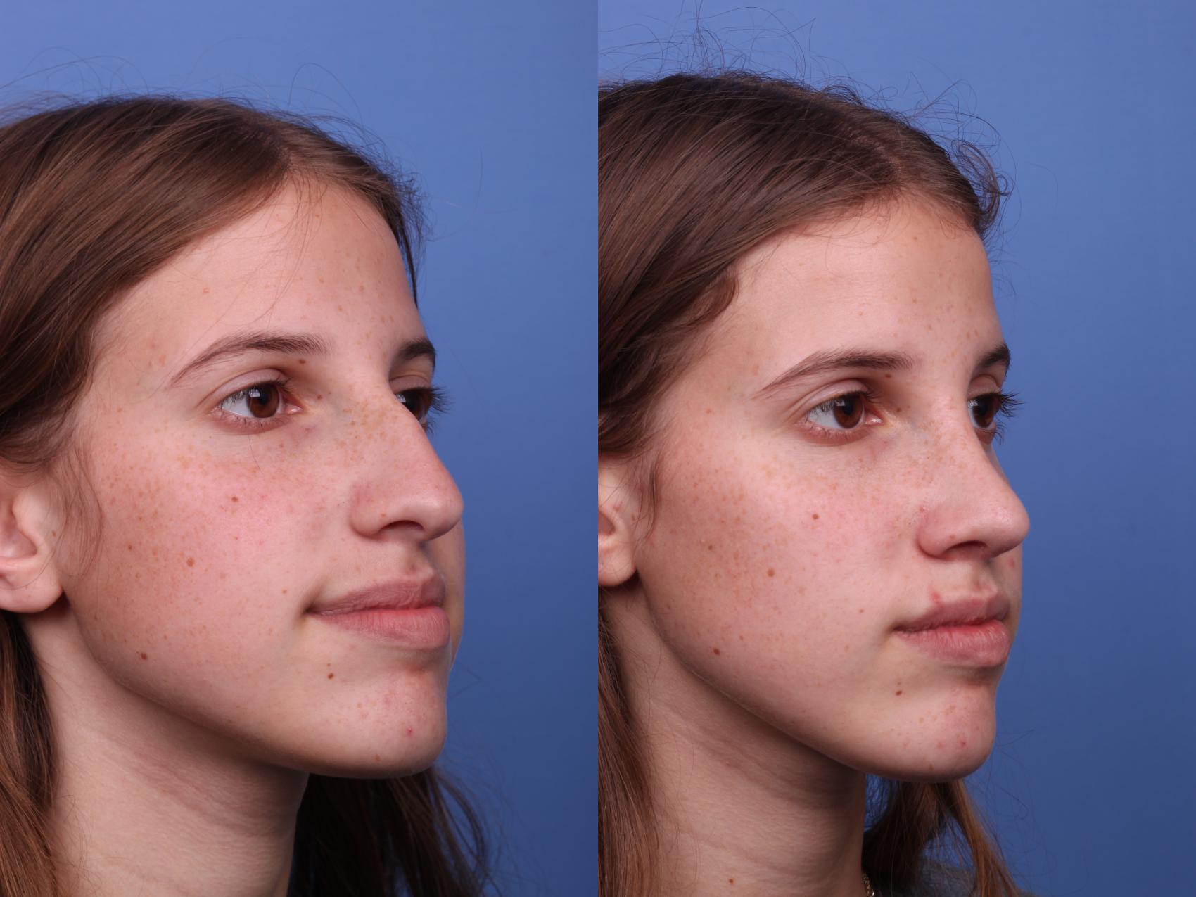 Before & After Rhinoplasty Case 500 Right Oblique View in Scottsdale, AZ