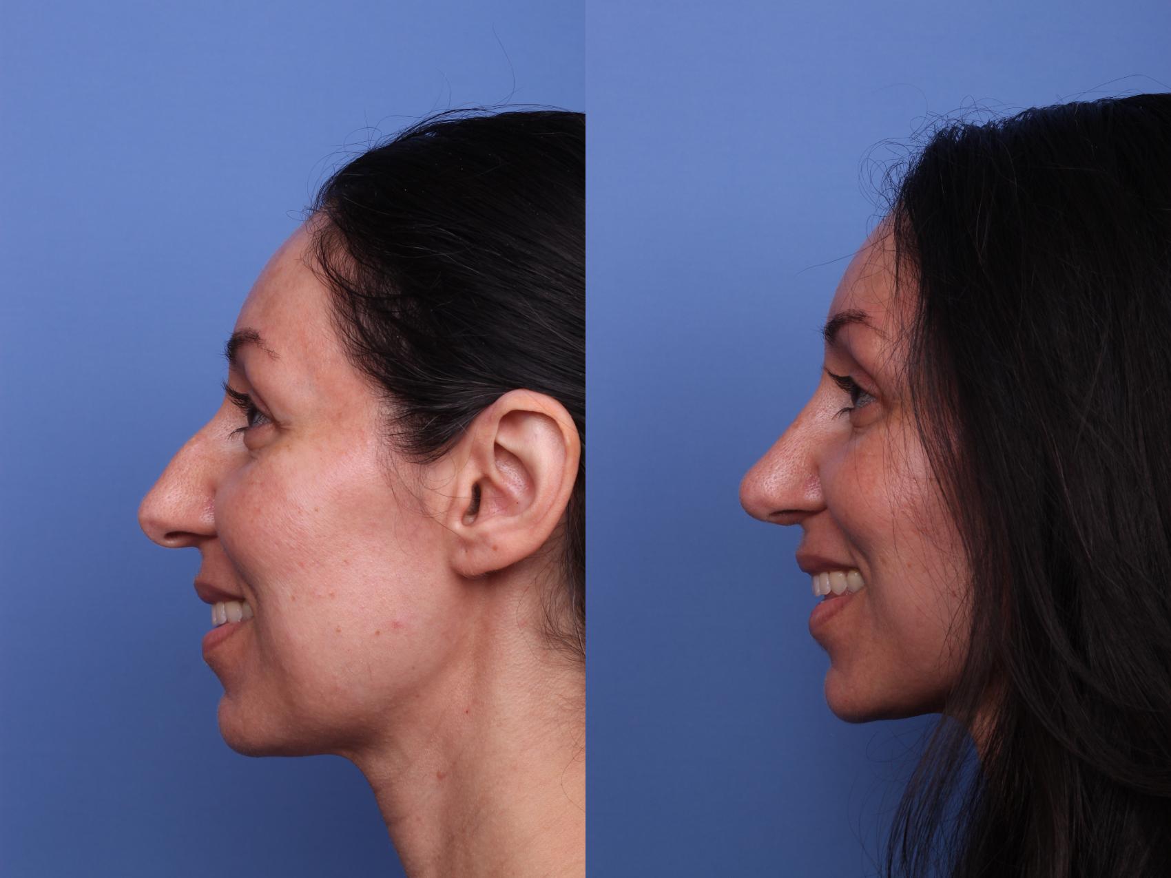 Before & After Rhinoplasty Case 501 Left Smile View in Scottsdale, AZ