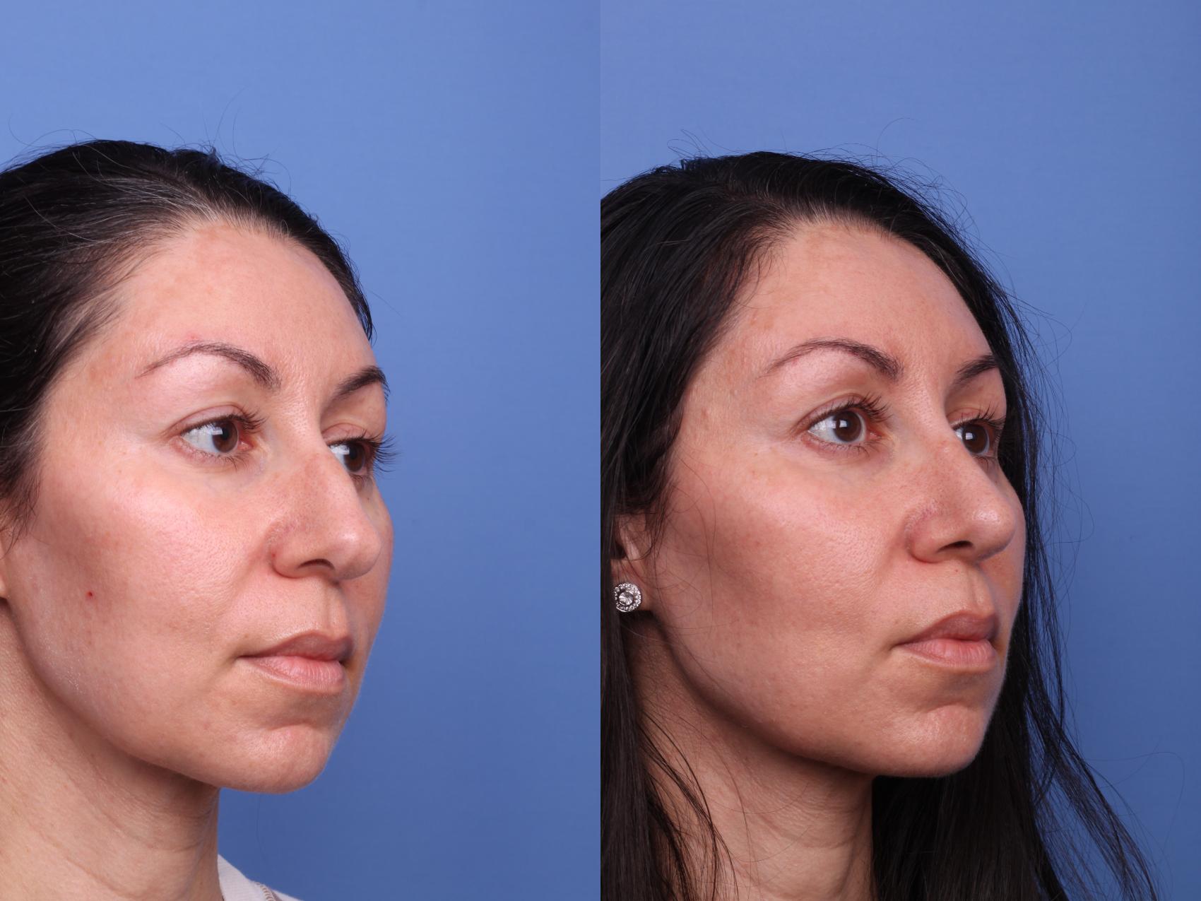 Before & After Rhinoplasty Case 501 Right Oblique View in Scottsdale, AZ
