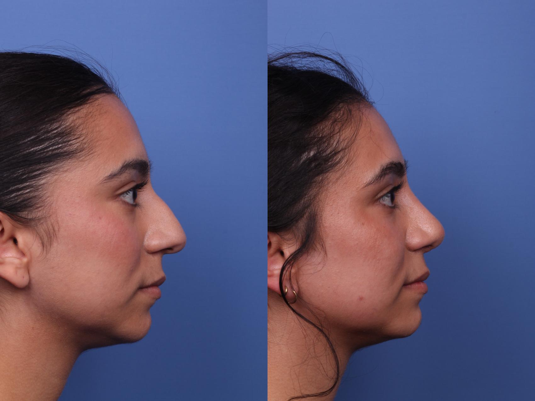 Before & After Rhinoplasty Case 504 Right Side View in Scottsdale, AZ