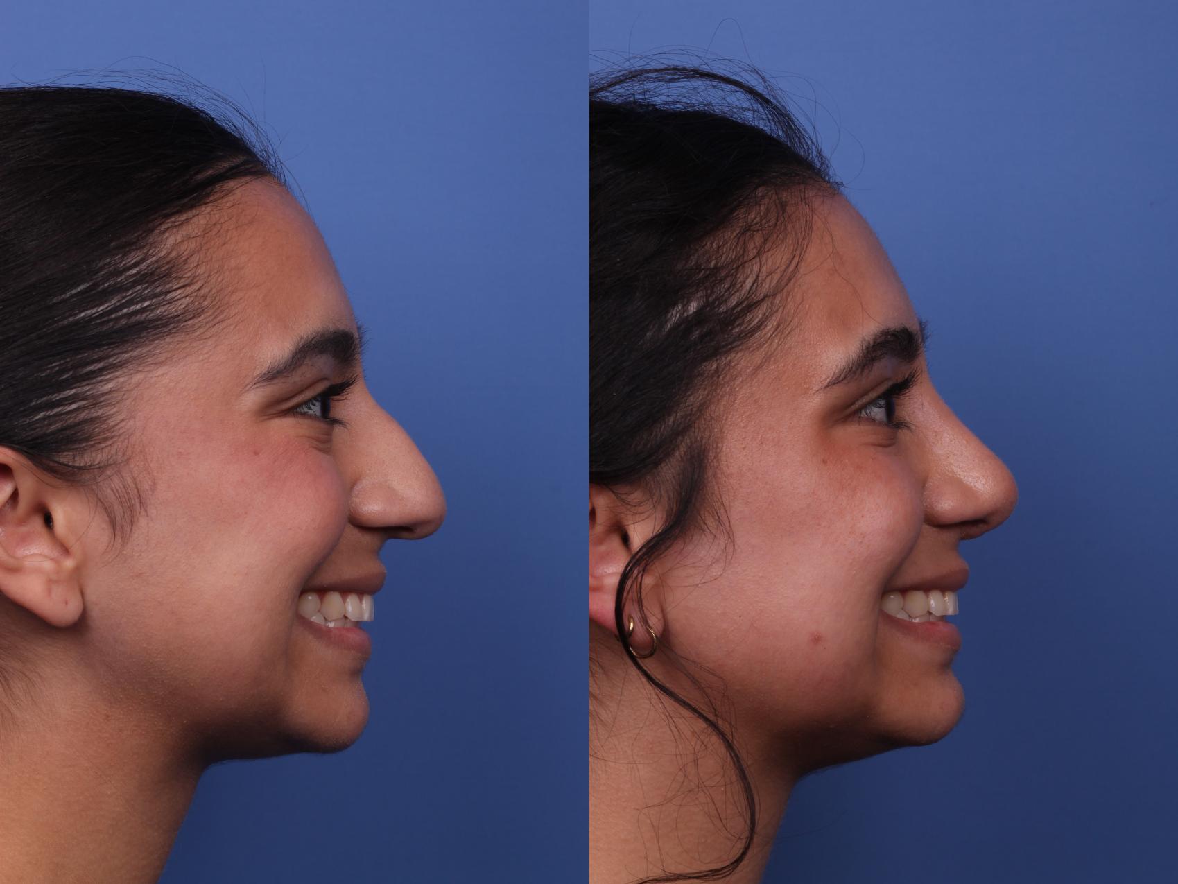 Before & After Rhinoplasty Case 504 Right Smile View in Scottsdale, AZ