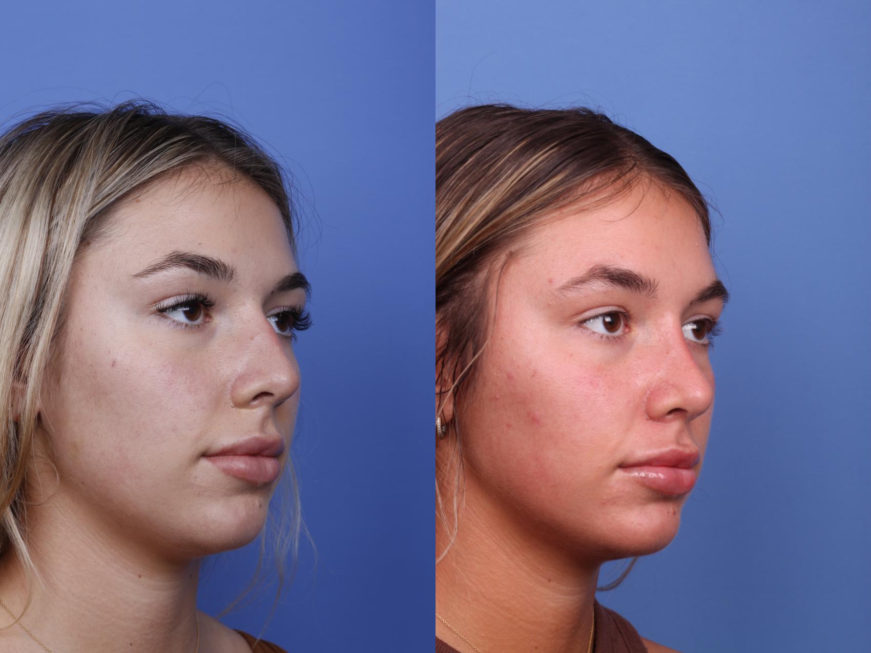 Before & After Rhinoplasty Case 507 Right Oblique View in Scottsdale, AZ