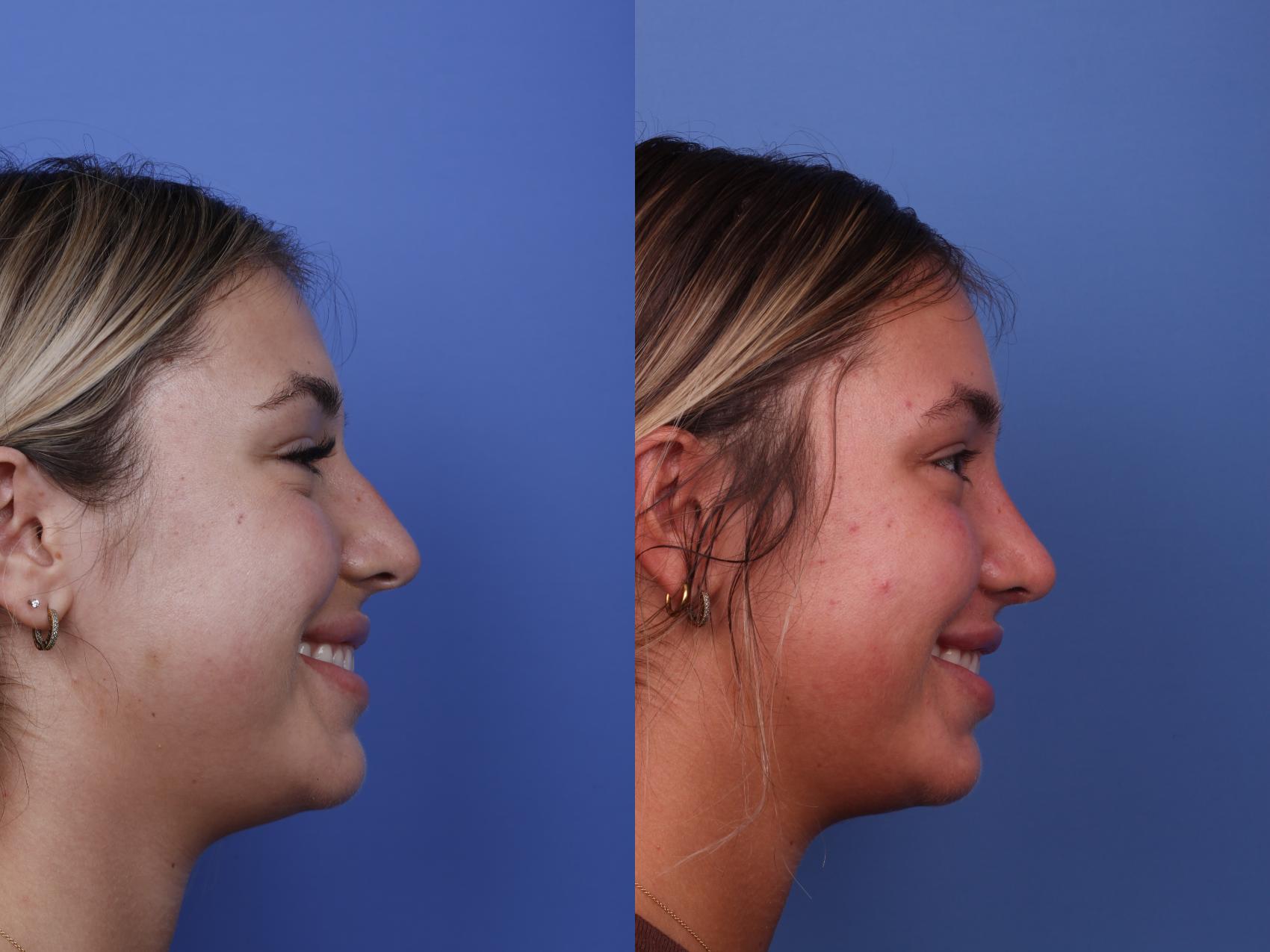 Before & After Rhinoplasty Case 507 Right Smile View in Scottsdale, AZ