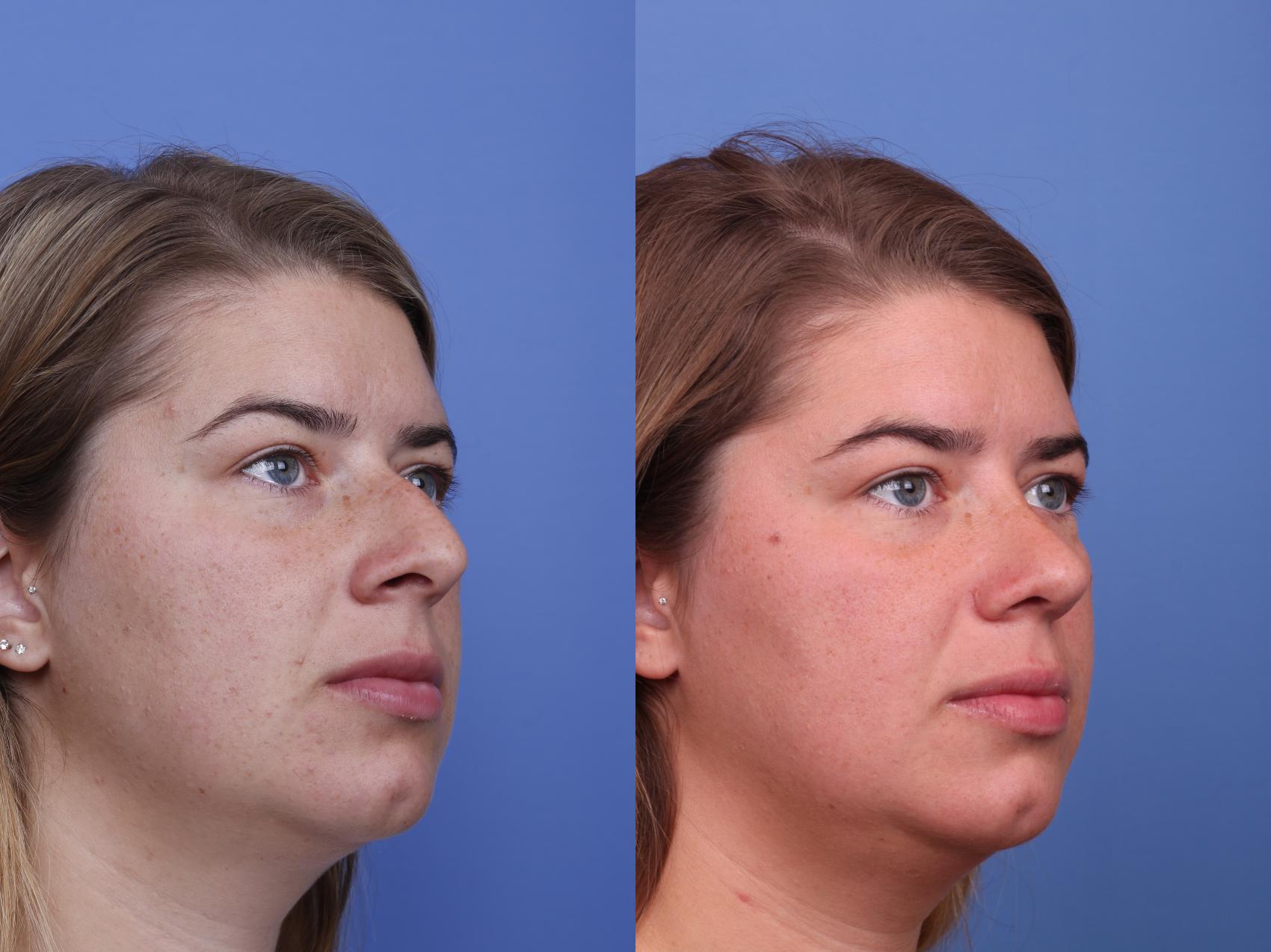 Before & After Rhinoplasty Case 508 Right Oblique View in Scottsdale, AZ