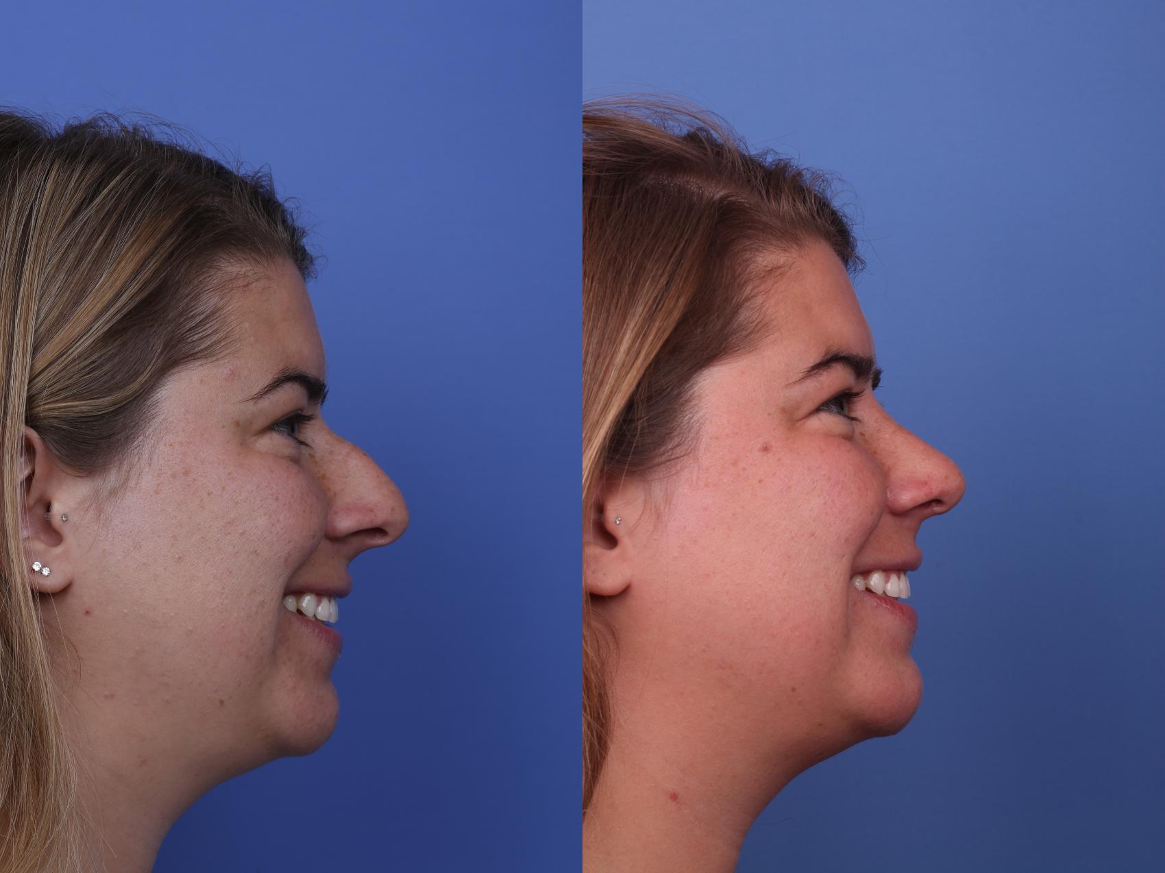 Before & After Rhinoplasty Case 508 Right Smile View in Scottsdale, AZ