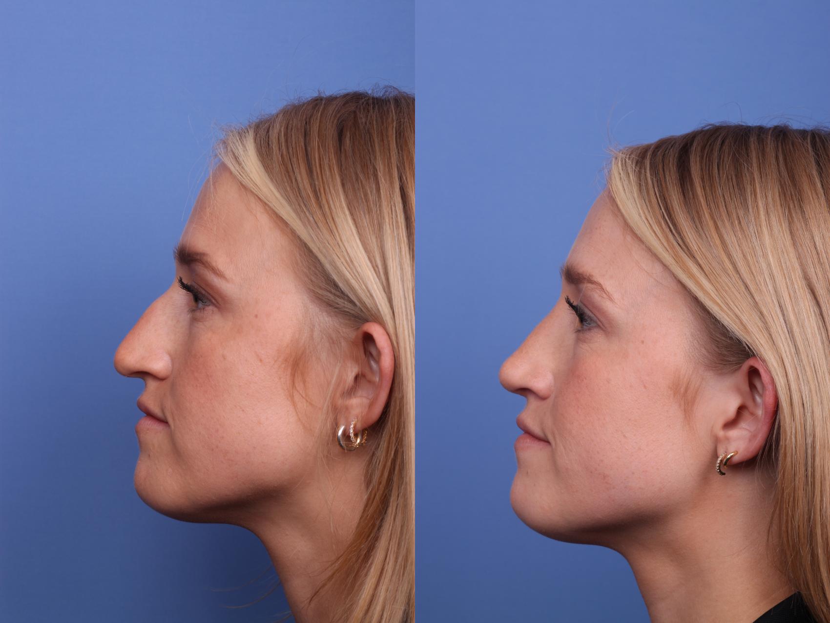 Before & After Rhinoplasty Case 509 Left Side View in Scottsdale, AZ