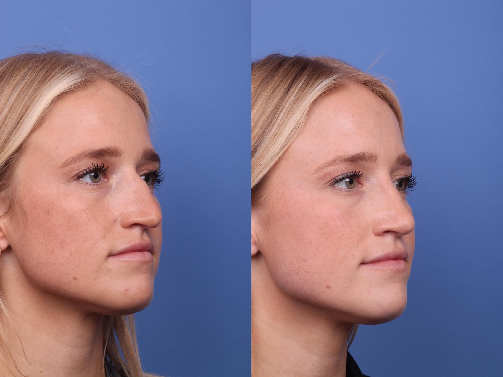 Before & After Rhinoplasty Case 509 Right Oblique View in Scottsdale, AZ