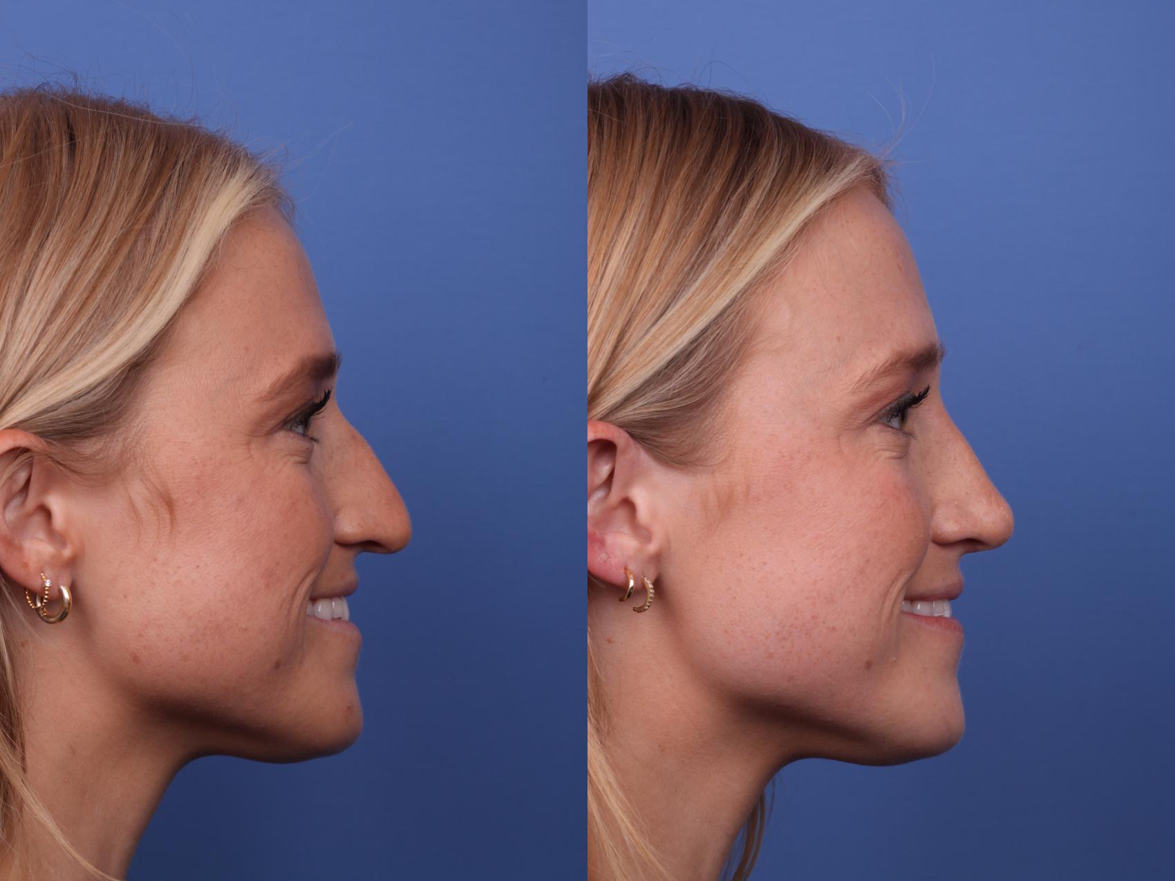 Before & After Rhinoplasty Case 509 Right Smile View in Scottsdale, AZ