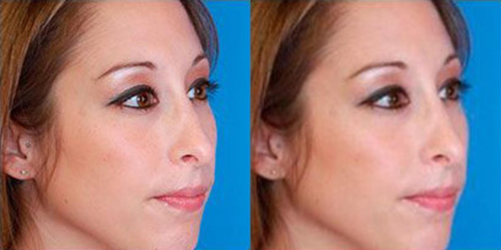 Before & After Rhinoplasty Case 51 View #2 View in Scottsdale, AZ