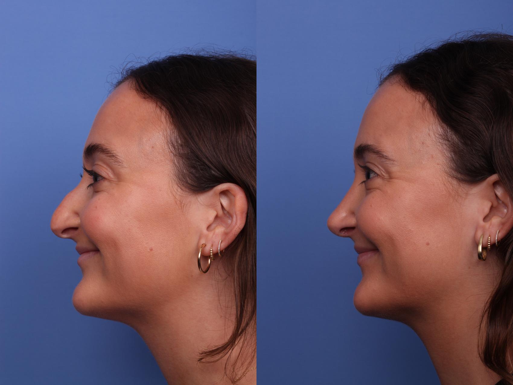 Before & After Rhinoplasty Case 510 Left Smile View in Scottsdale, AZ